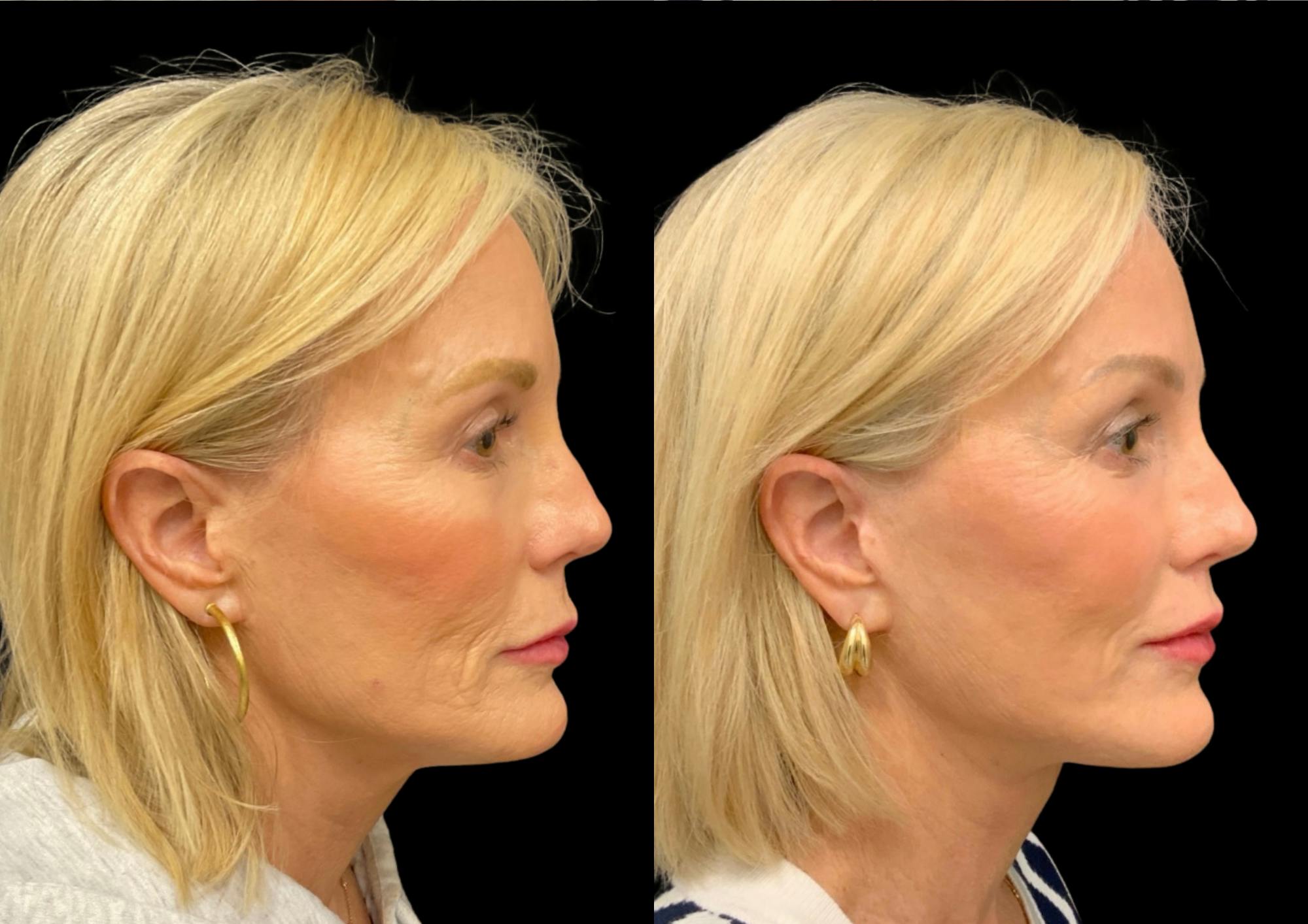 Neck Lift Before & After Gallery - Patient 265142 - Image 5
