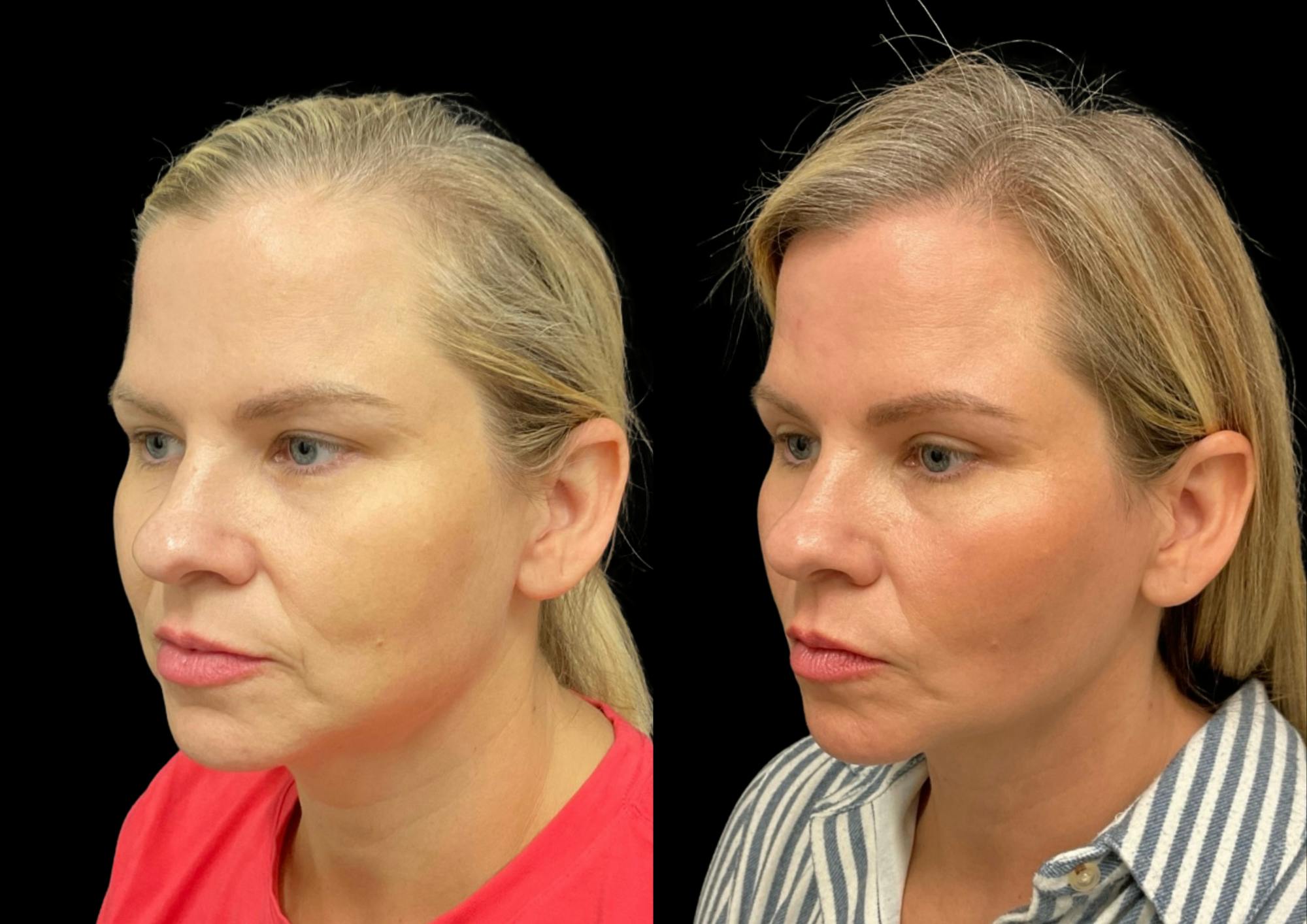 Buccal Fat Reduction Before & After Gallery - Patient 264924 - Image 2
