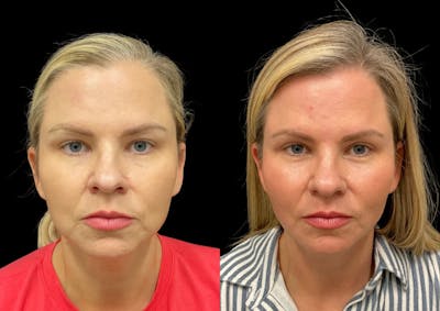 Buccal Fat Reduction Before & After Gallery - Patient 264924 - Image 1