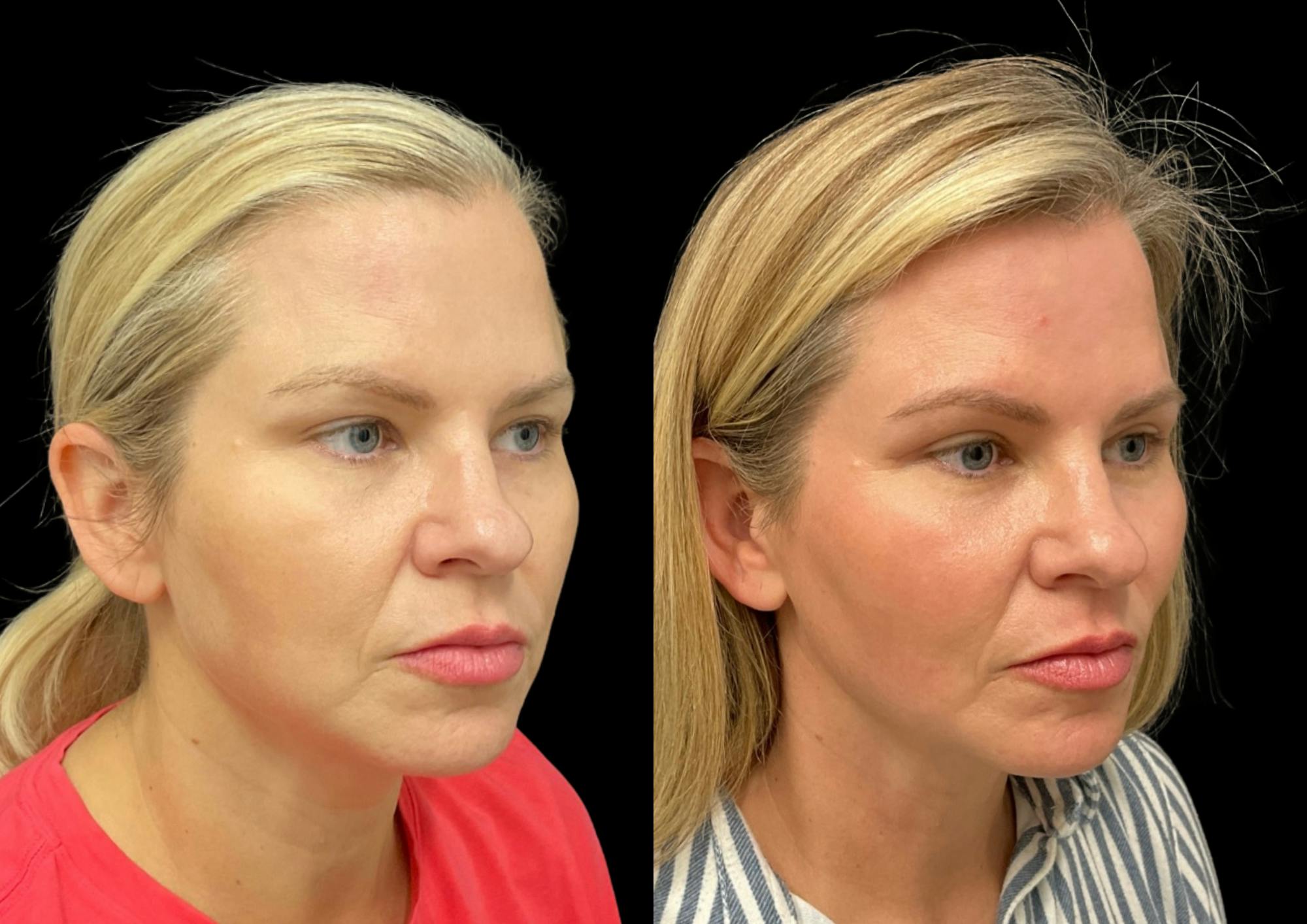 Buccal Fat Reduction Before & After Gallery - Patient 264924 - Image 3