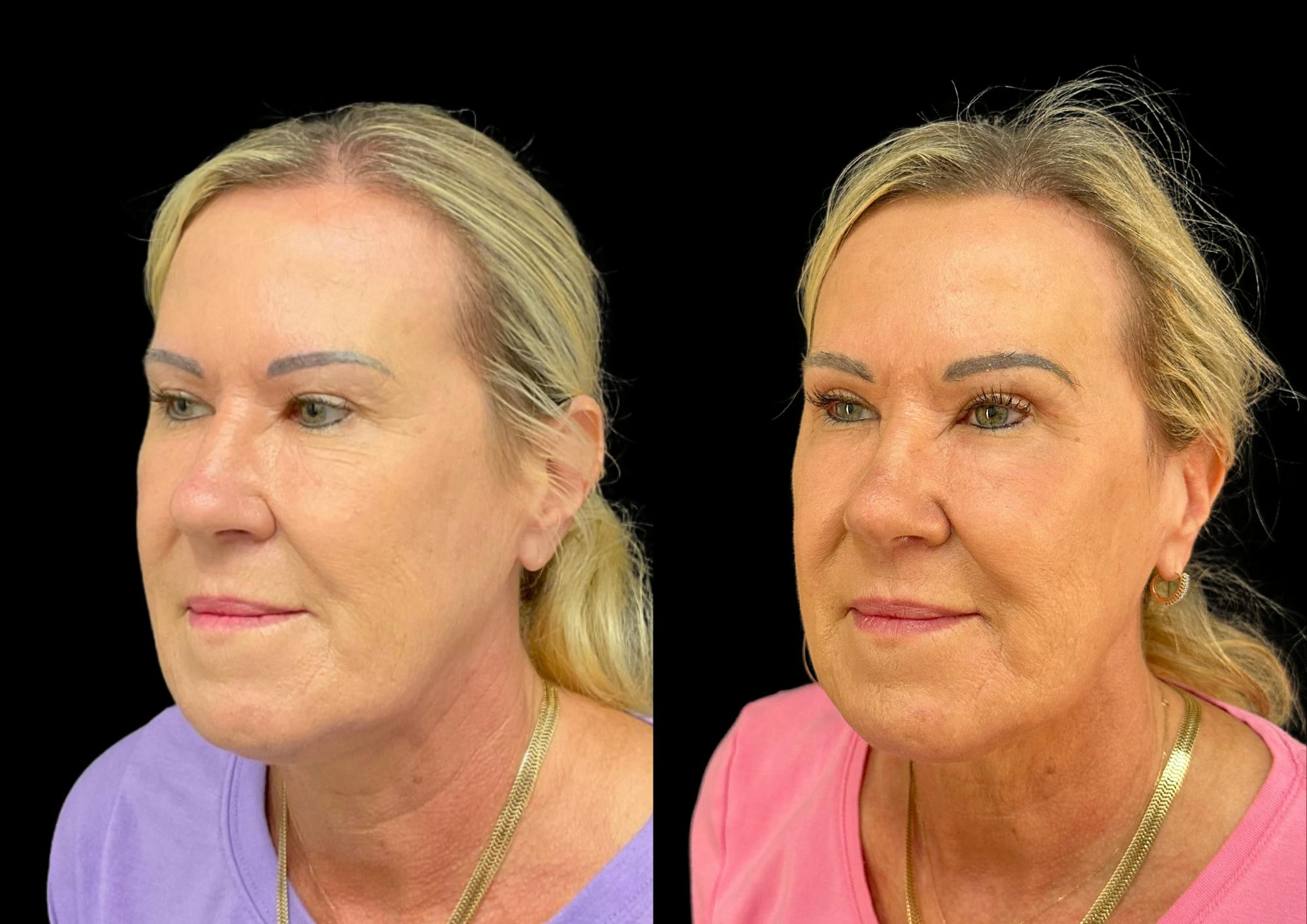 Upper Blepharoplasty Before & After Gallery - Patient 281683 - Image 2