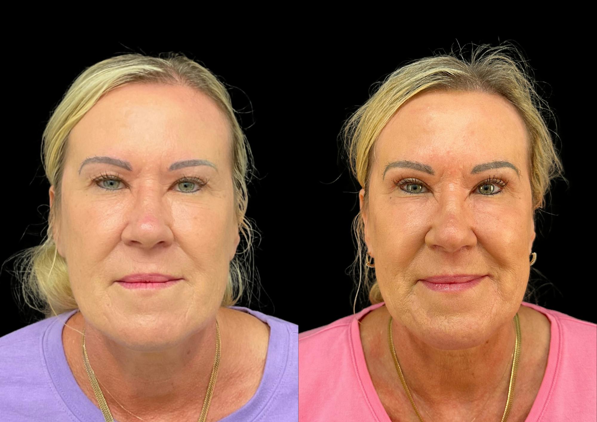 Upper Blepharoplasty Before & After Gallery - Patient 281683 - Image 1