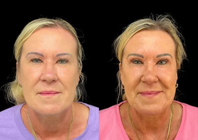 Laser Skin Resurfacing Before & After Gallery - Patient 222265 - Image 1