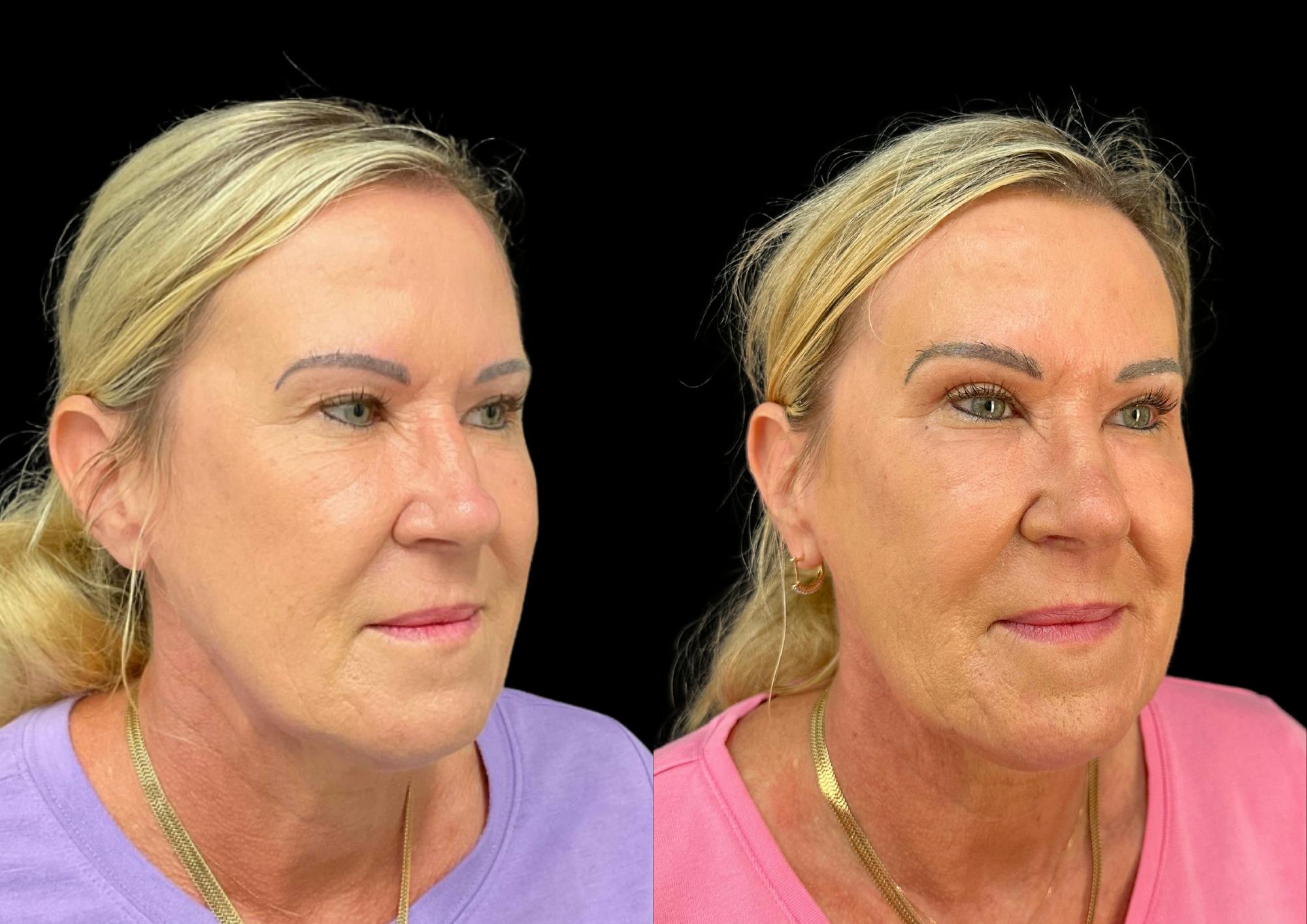 Upper Blepharoplasty Before & After Gallery - Patient 281683 - Image 3