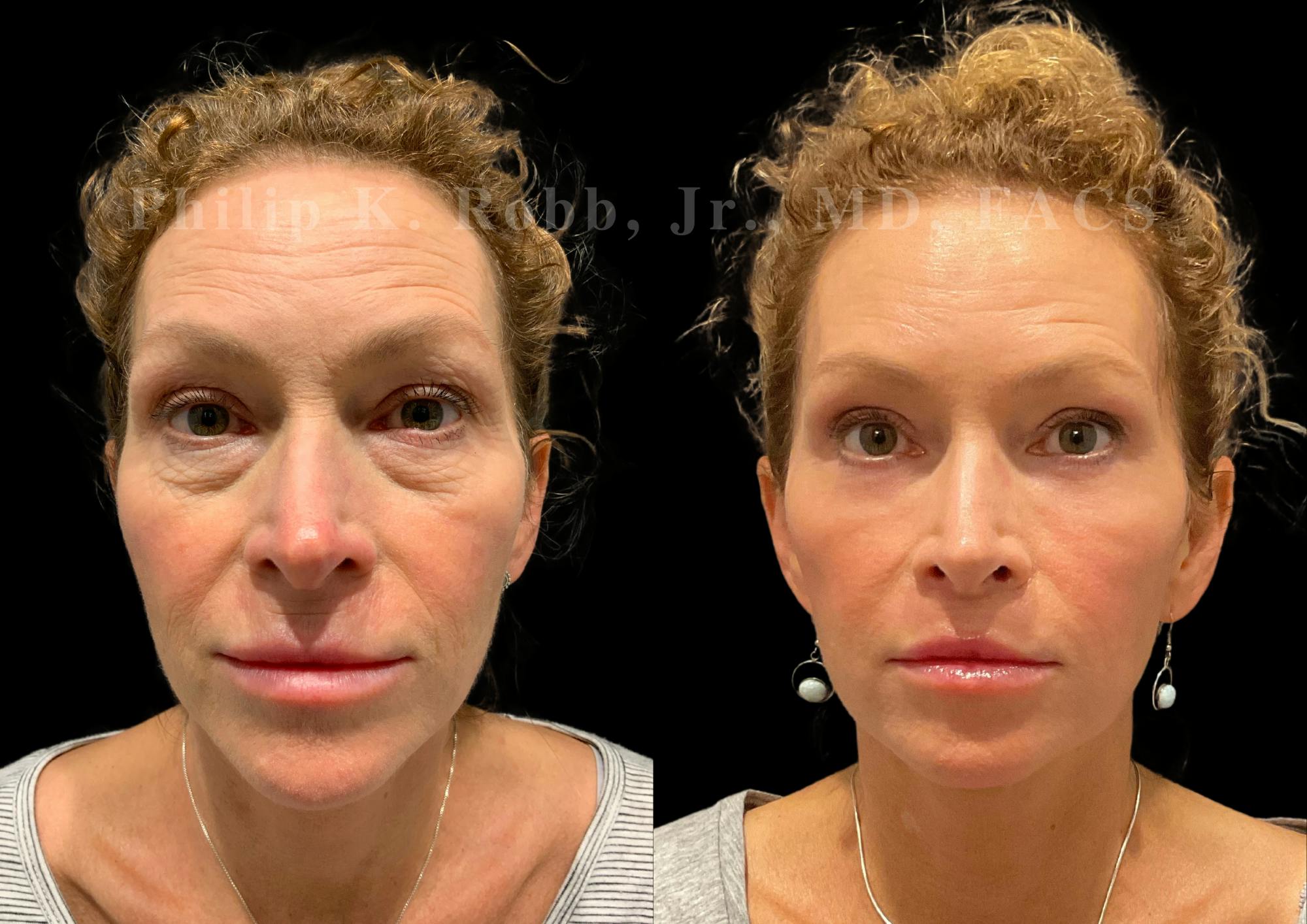 Lower Blepharoplasty Before & After Gallery - Patient 382457 - Image 1