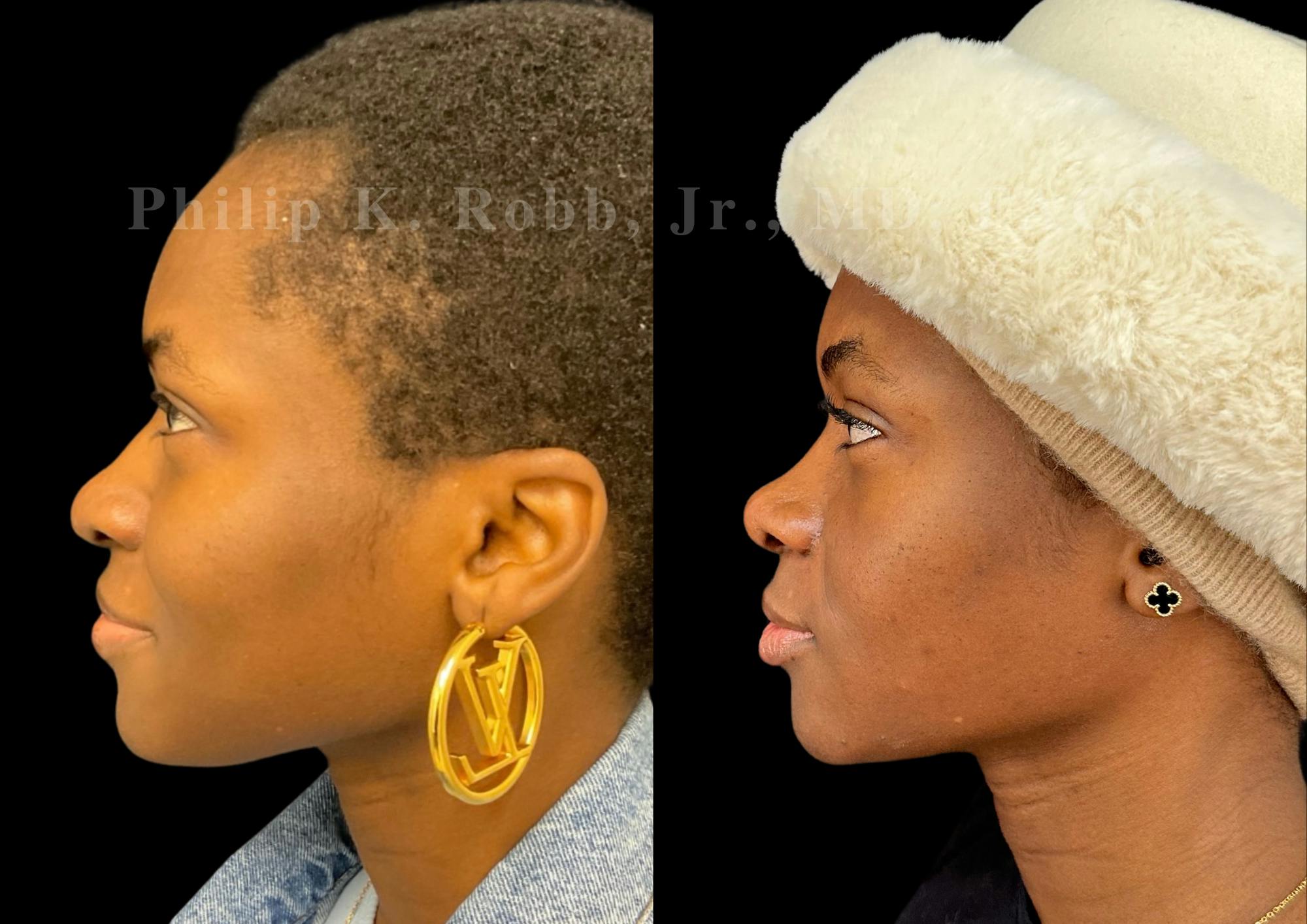 Ultrasonic Rhinoplasty Before & After Gallery - Patient 249883 - Image 5