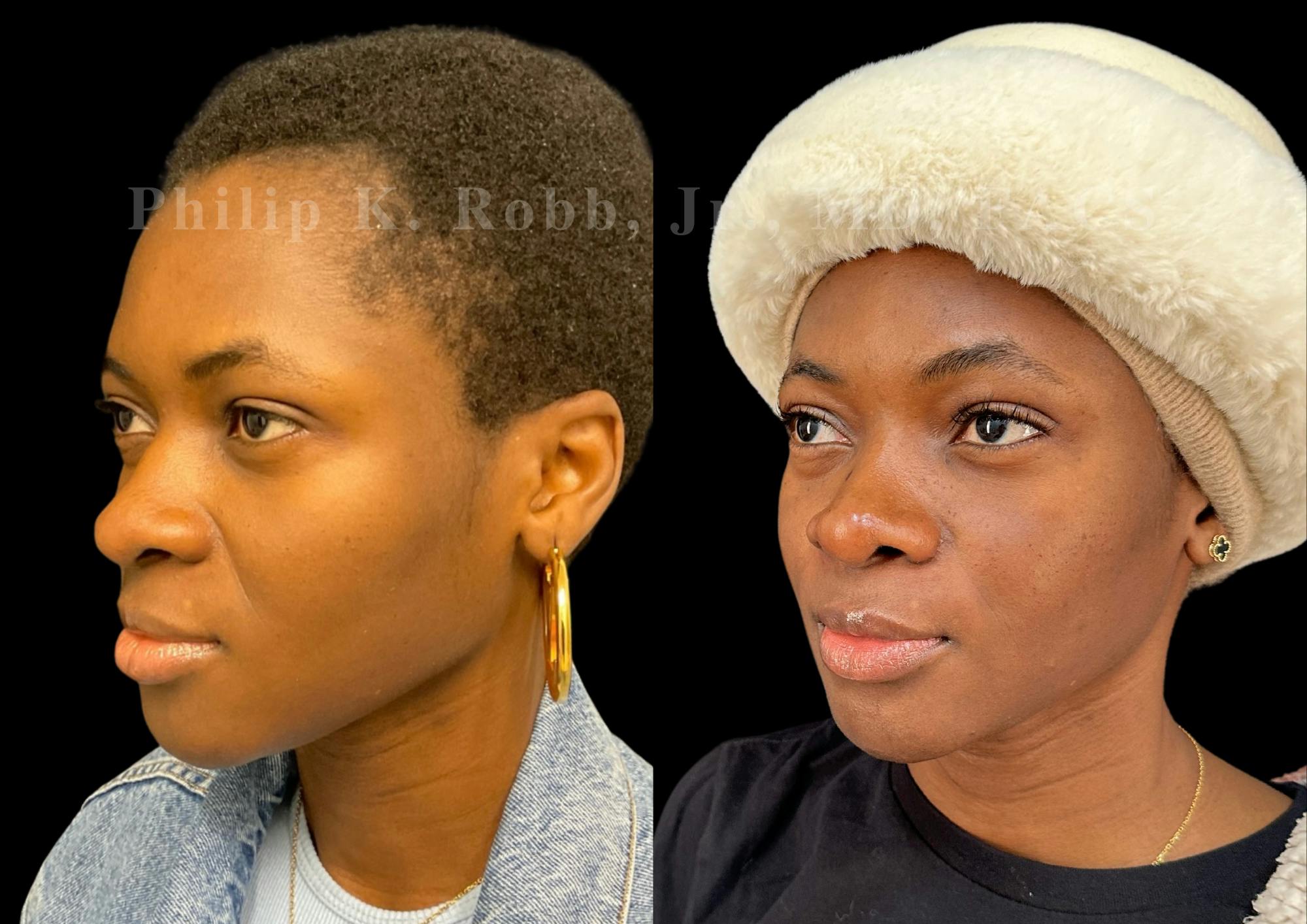 Ultrasonic Rhinoplasty Before & After Gallery - Patient 249883 - Image 4