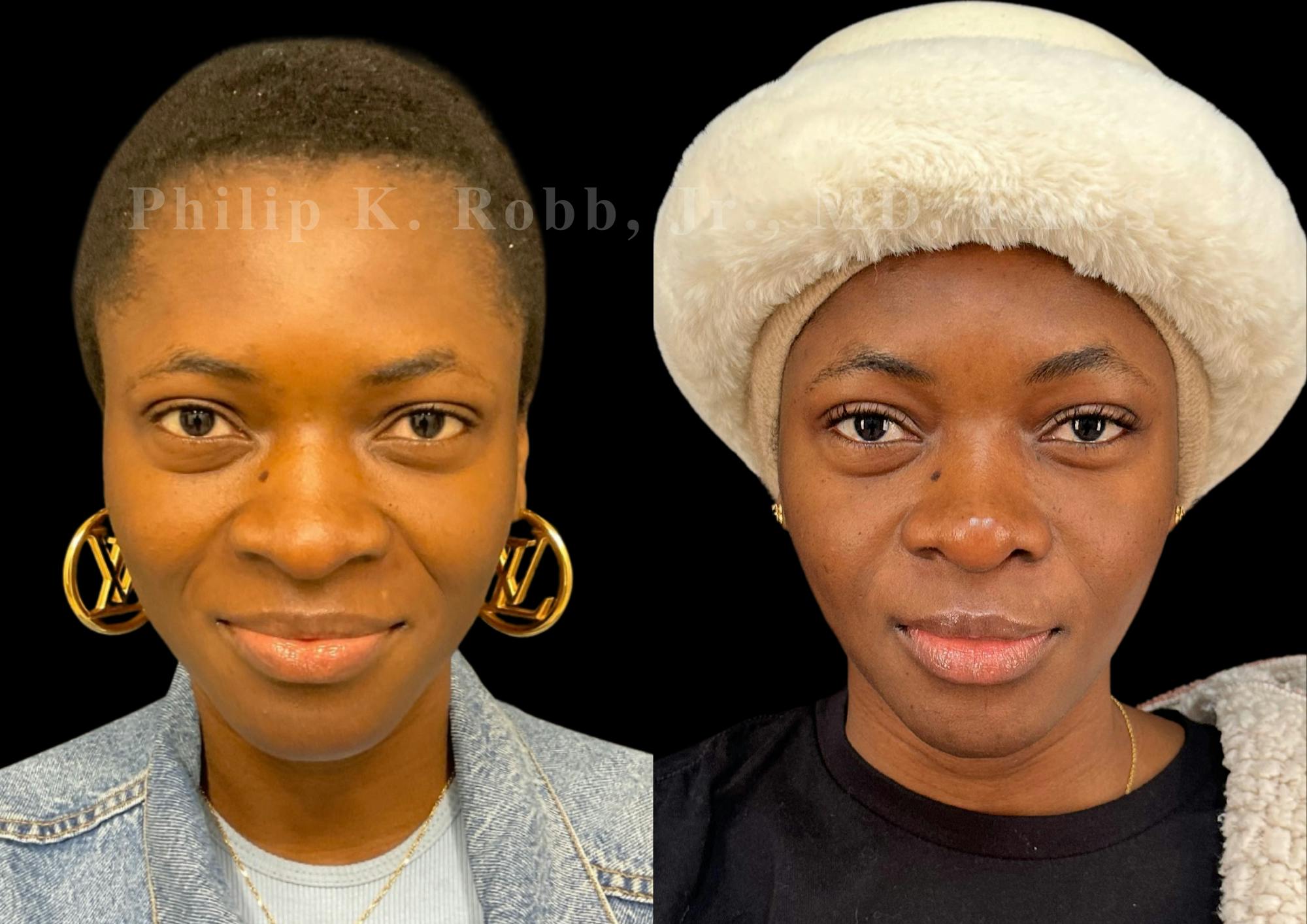 Ultrasonic Rhinoplasty Before & After Gallery - Patient 249883 - Image 3