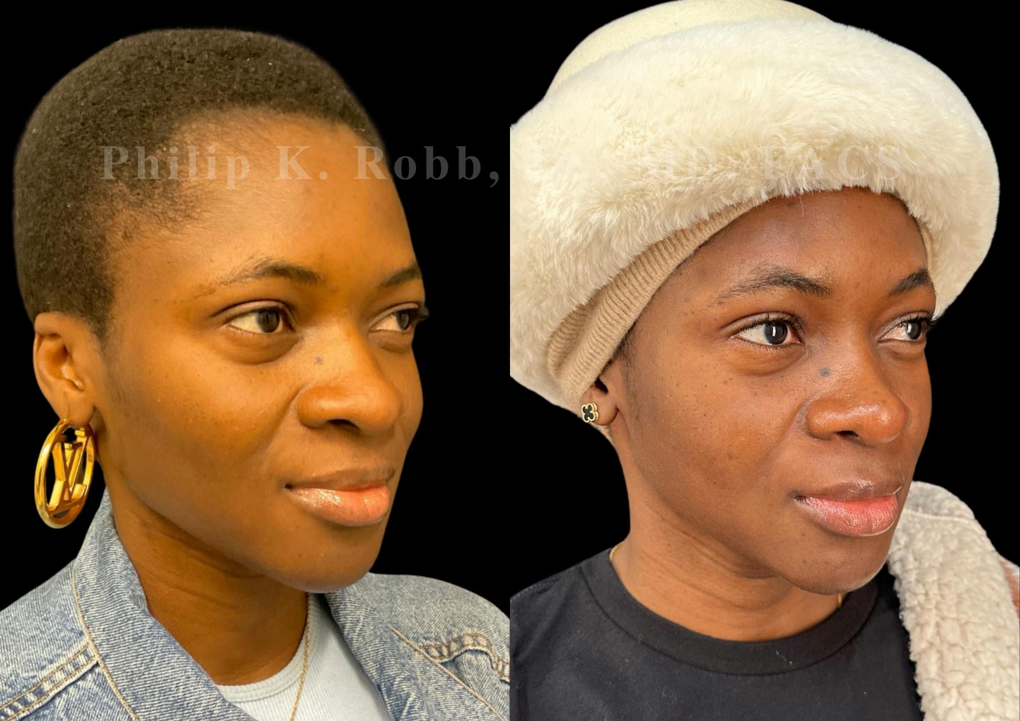 Ultrasonic Rhinoplasty Before & After Gallery - Patient 249883 - Image 2