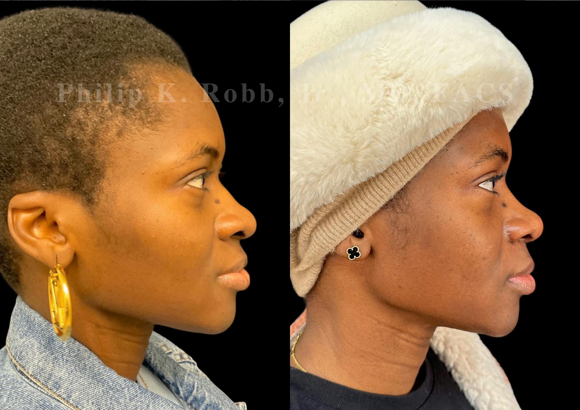 Ultrasonic Rhinoplasty Before & After Gallery - Patient 249883 - Image 1