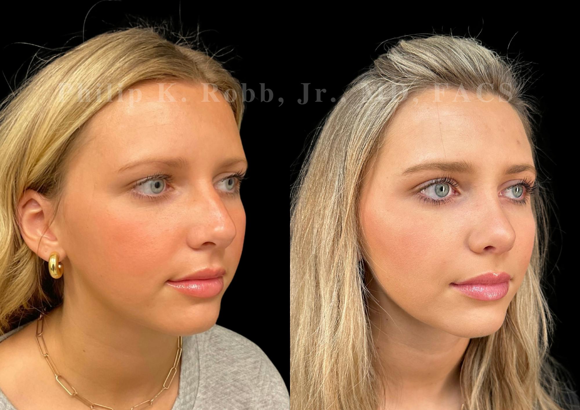 Ultrasonic Rhinoplasty Before & After Gallery - Patient 225769 - Image 2