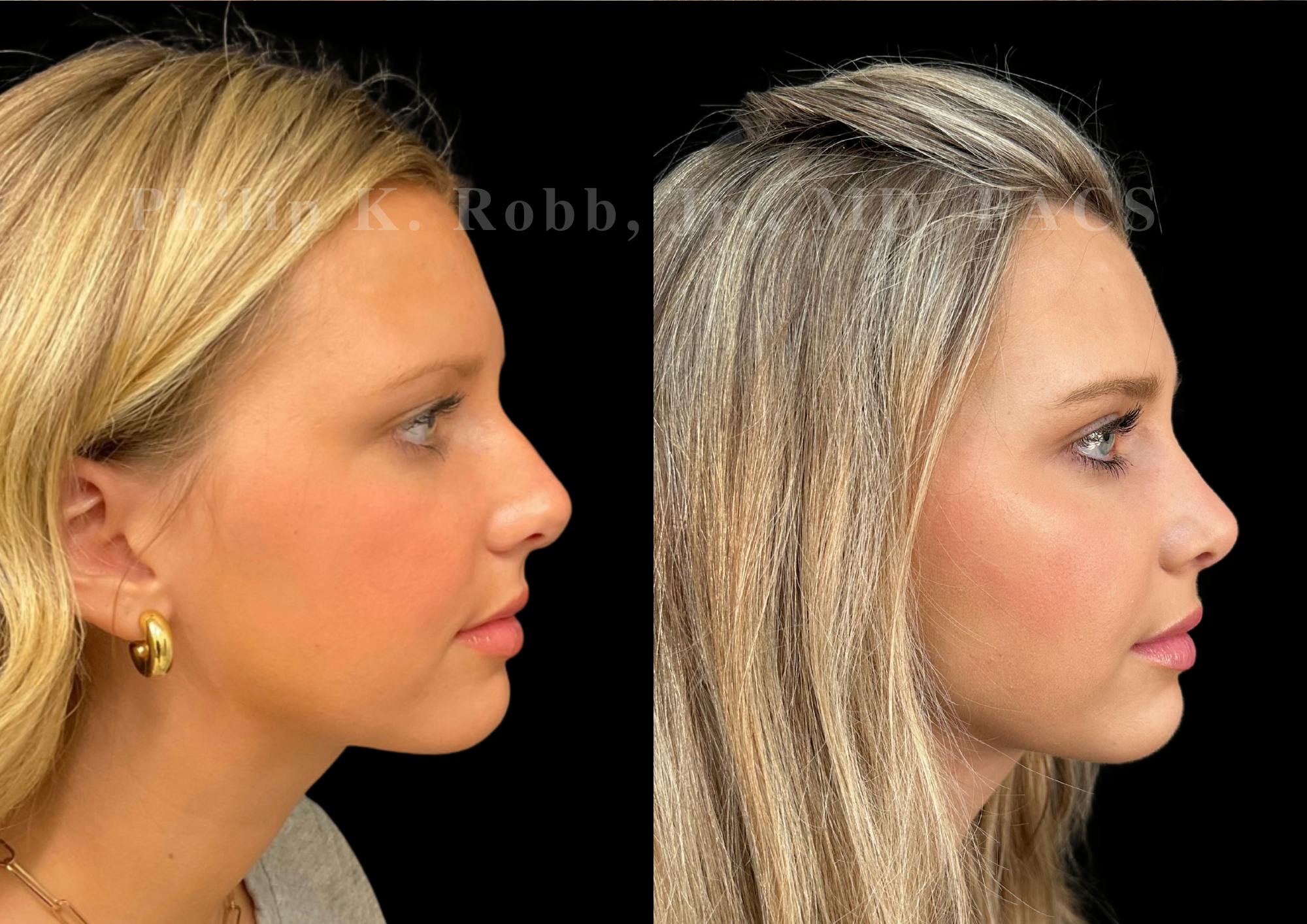 Ultrasonic Rhinoplasty Before & After Gallery - Patient 225769 - Image 1