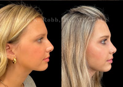Ultrasonic Rhinoplasty Before & After Gallery - Patient 225769 - Image 1