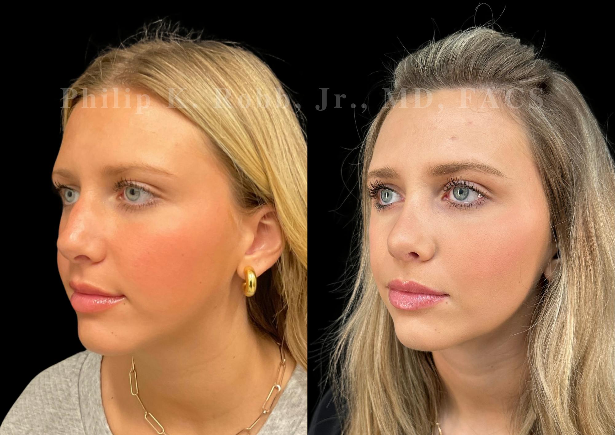 Ultrasonic Rhinoplasty Before & After Gallery - Patient 225769 - Image 4