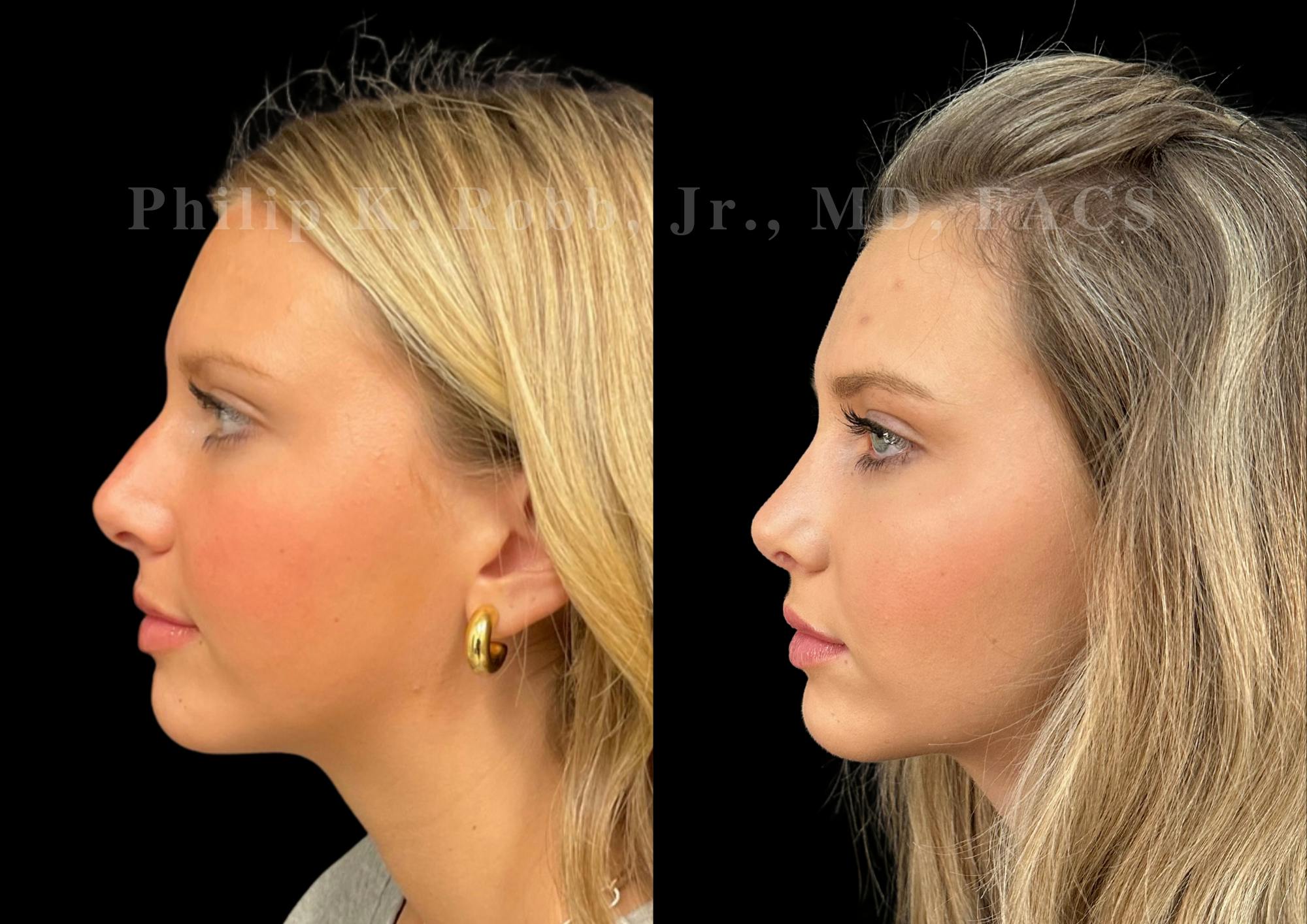 Ultrasonic Rhinoplasty Before & After Gallery - Patient 225769 - Image 5