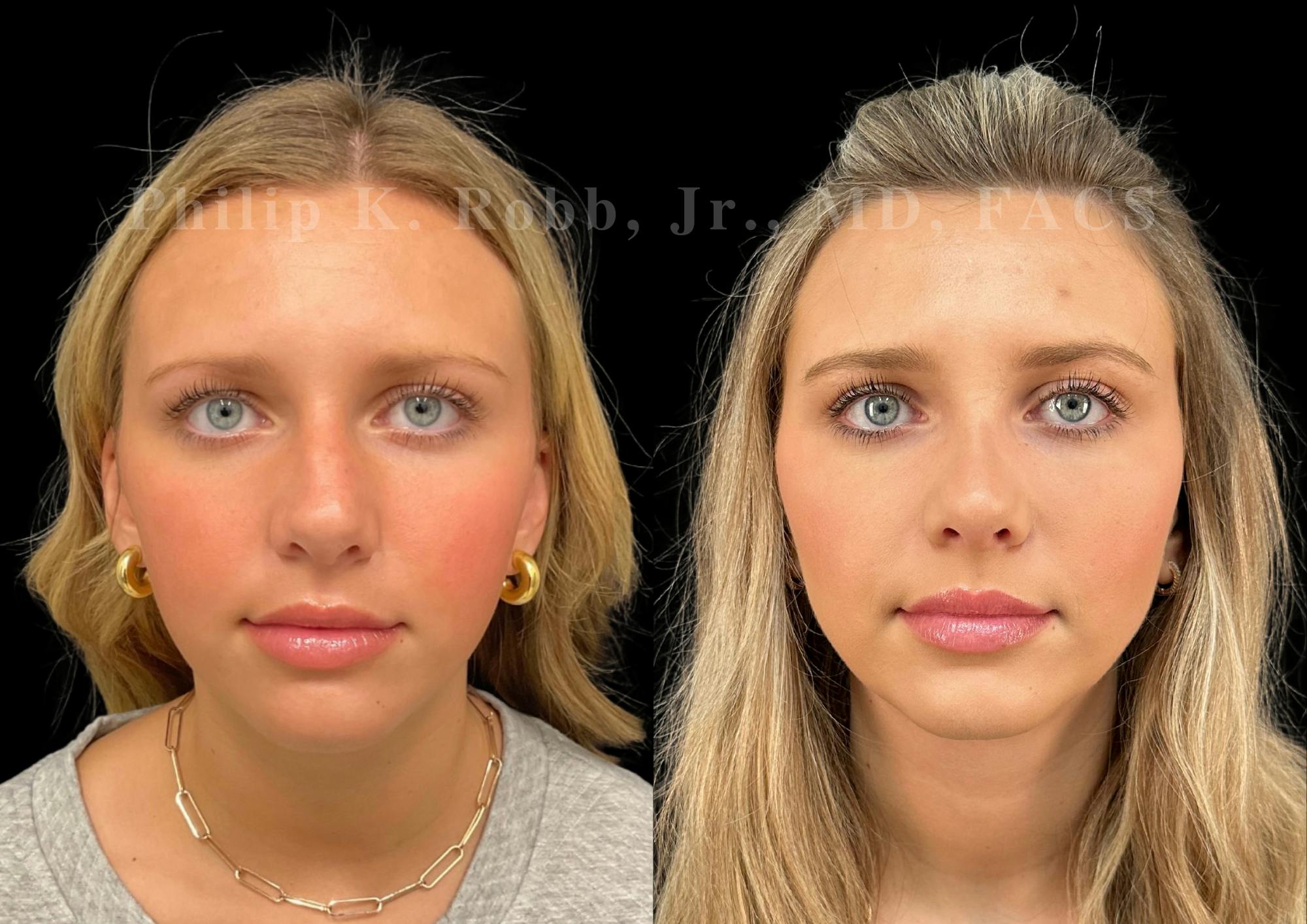 Ultrasonic Rhinoplasty Before & After Gallery - Patient 225769 - Image 3