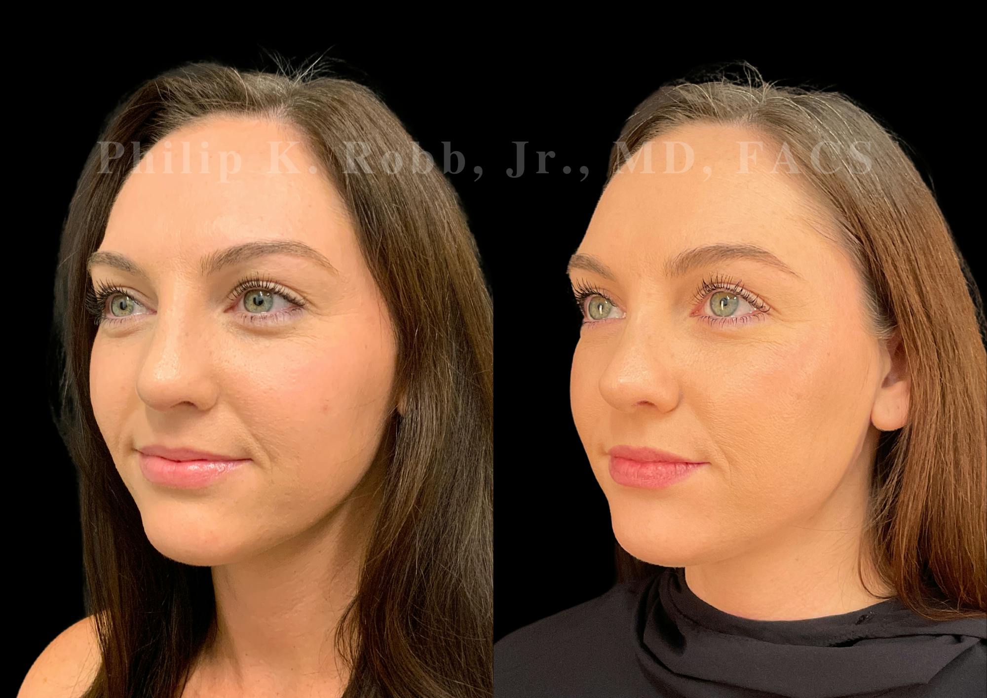 Ultrasonic Rhinoplasty Before & After Gallery - Patient 232426 - Image 4