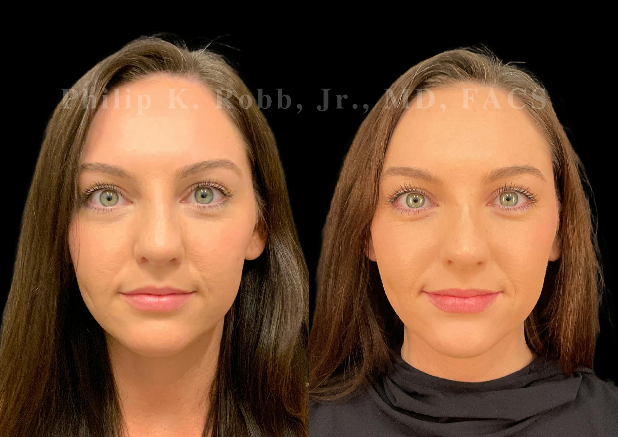 Ultrasonic Rhinoplasty Before & After Gallery - Patient 232426 - Image 3