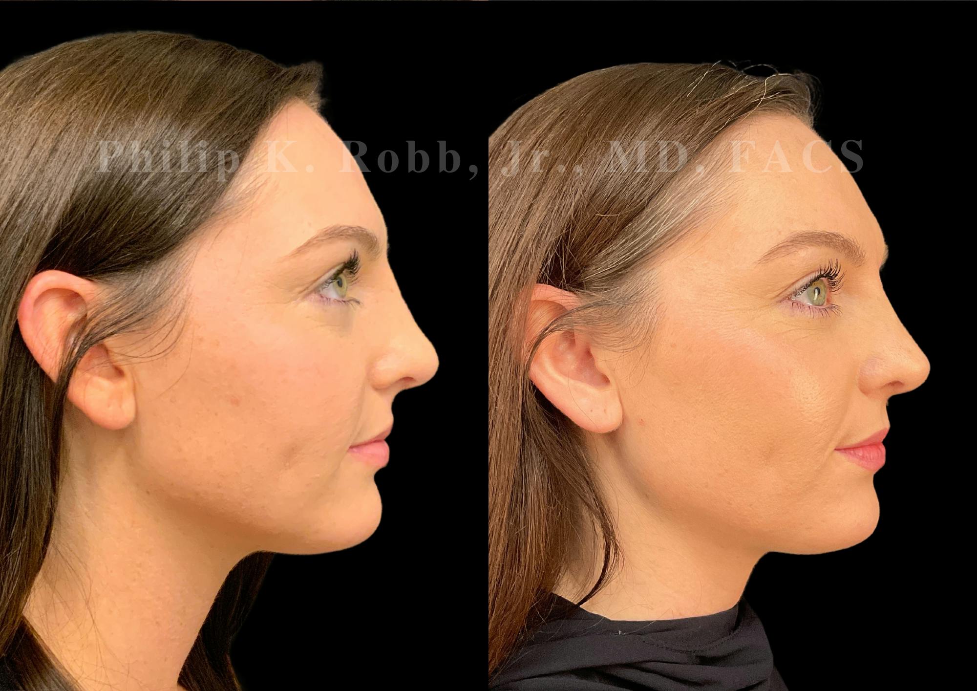 Ultrasonic Rhinoplasty Before & After Gallery - Patient 232426 - Image 1