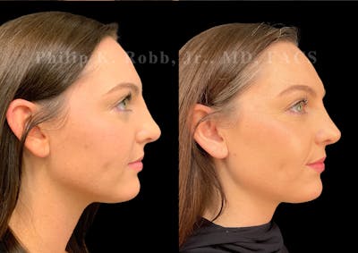 Ultrasonic Rhinoplasty Before & After Gallery - Patient 232426 - Image 1