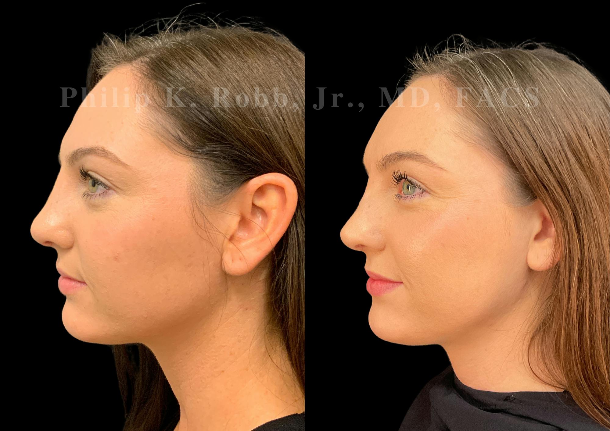 Ultrasonic Rhinoplasty Before & After Gallery - Patient 232426 - Image 5