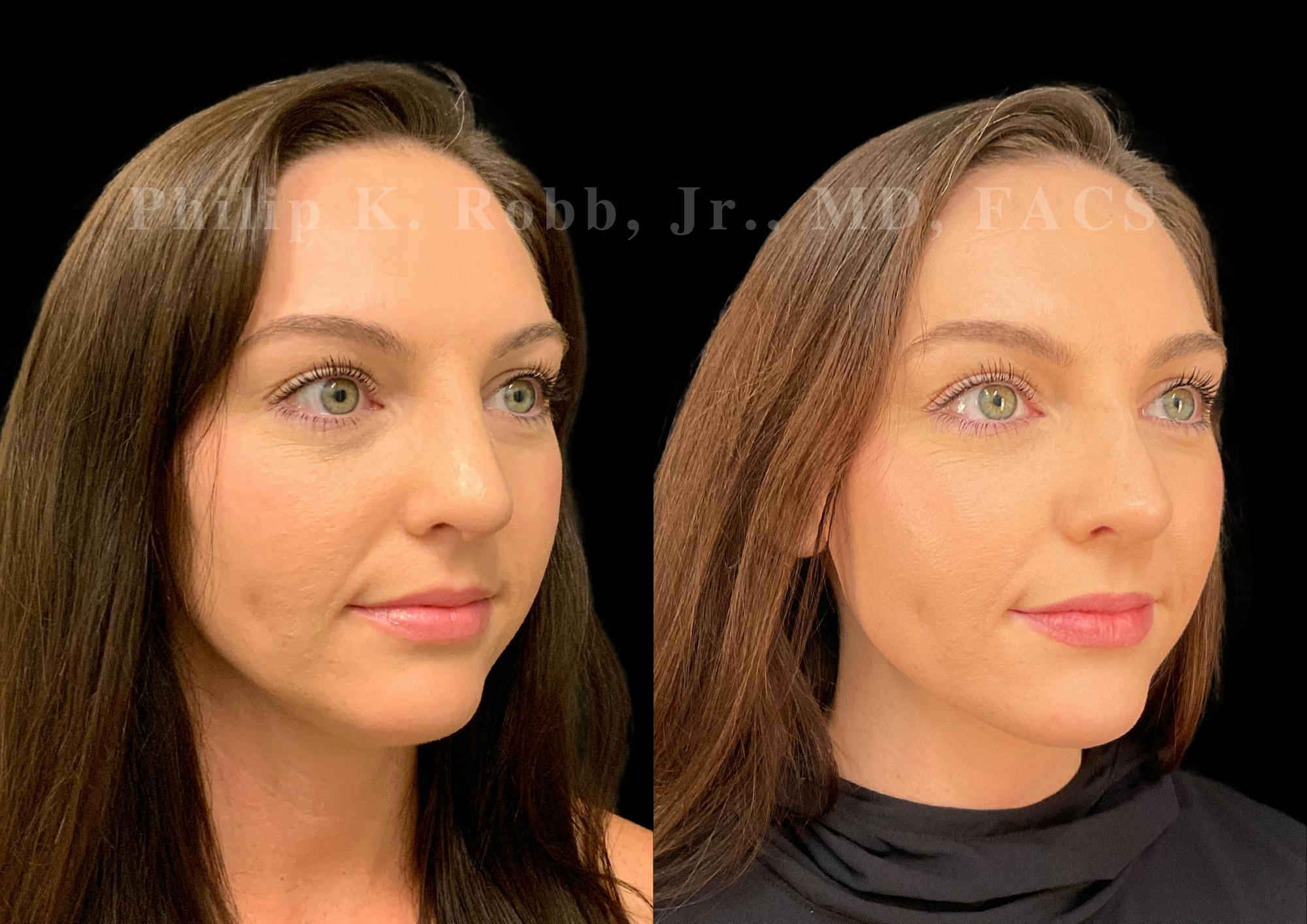 Ultrasonic Rhinoplasty Before & After Gallery - Patient 232426 - Image 2