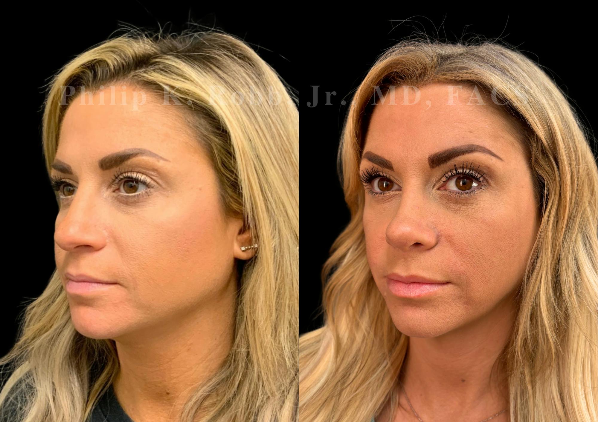 Ultrasonic Rhinoplasty Before & After Gallery - Patient 227186 - Image 4