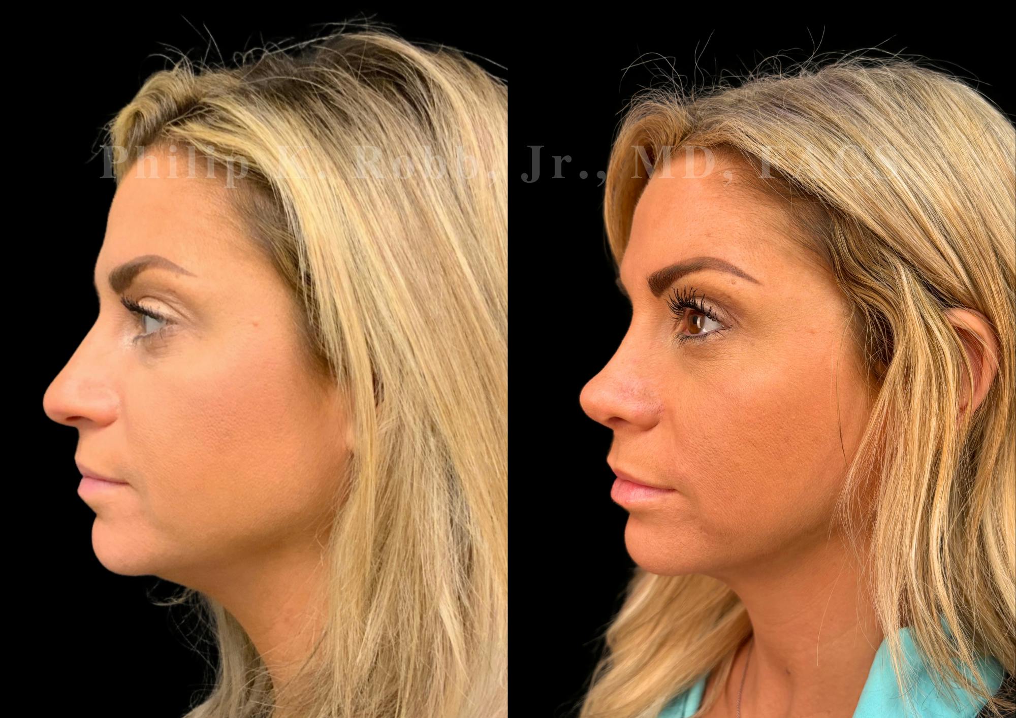Ultrasonic Rhinoplasty Before & After Gallery - Patient 227186 - Image 5