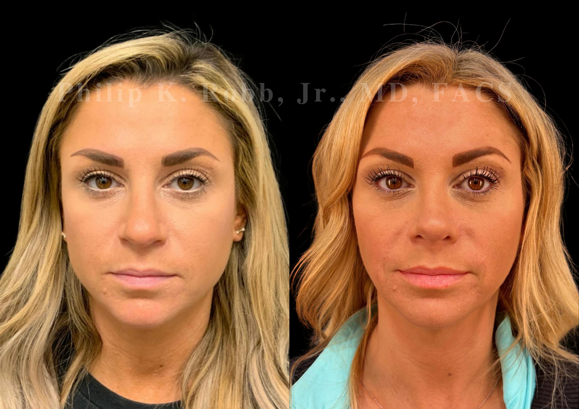 Ultrasonic Rhinoplasty Before & After Gallery - Patient 227186 - Image 3
