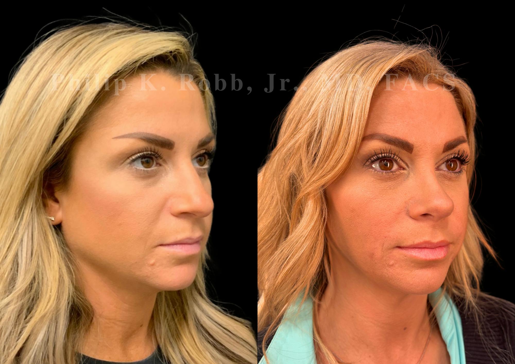 Ultrasonic Rhinoplasty Before & After Gallery - Patient 227186 - Image 2