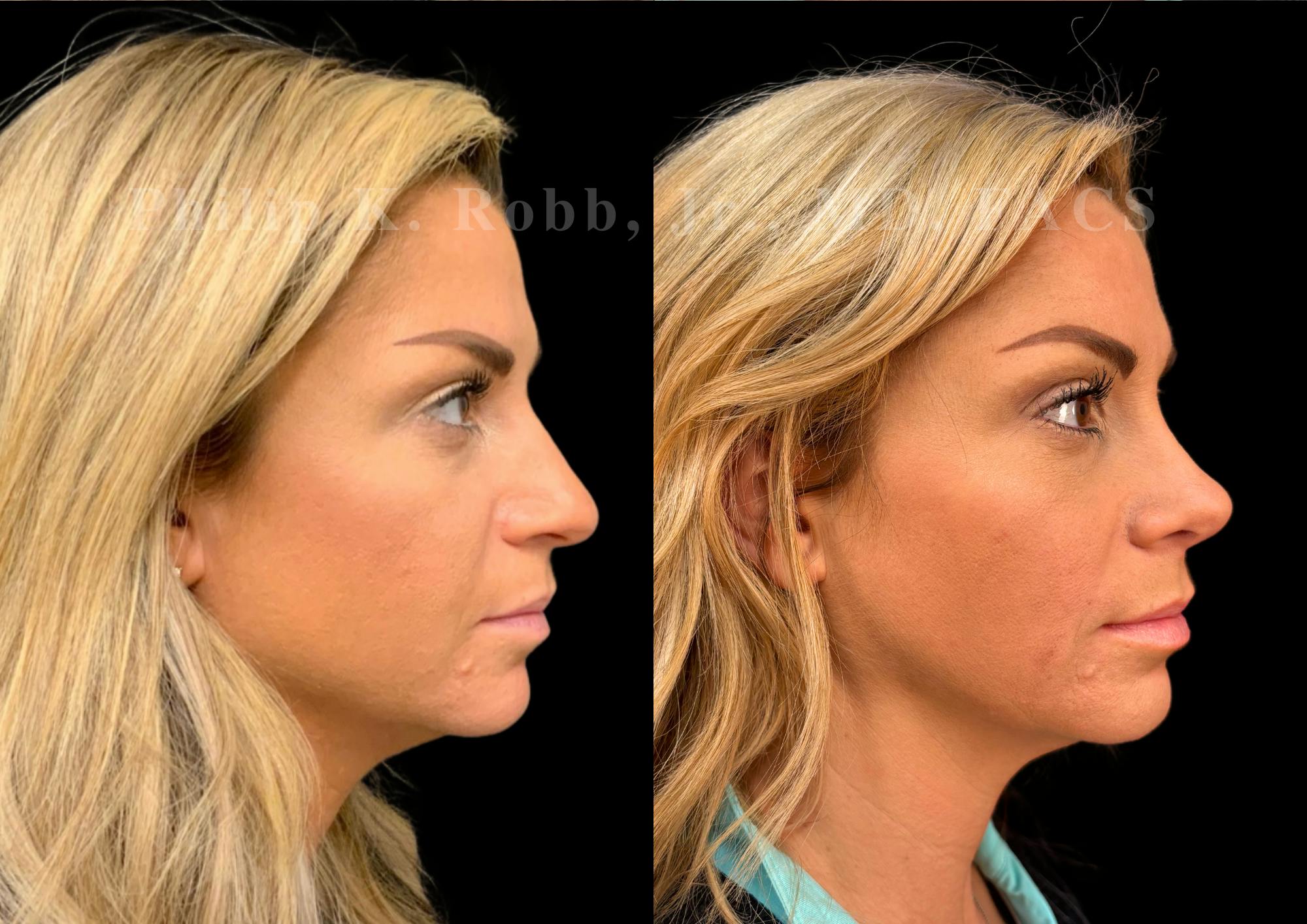 Ultrasonic Rhinoplasty Before & After Gallery - Patient 227186 - Image 1