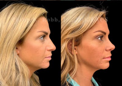 Ultrasonic Rhinoplasty Before & After Gallery - Patient 227186 - Image 1