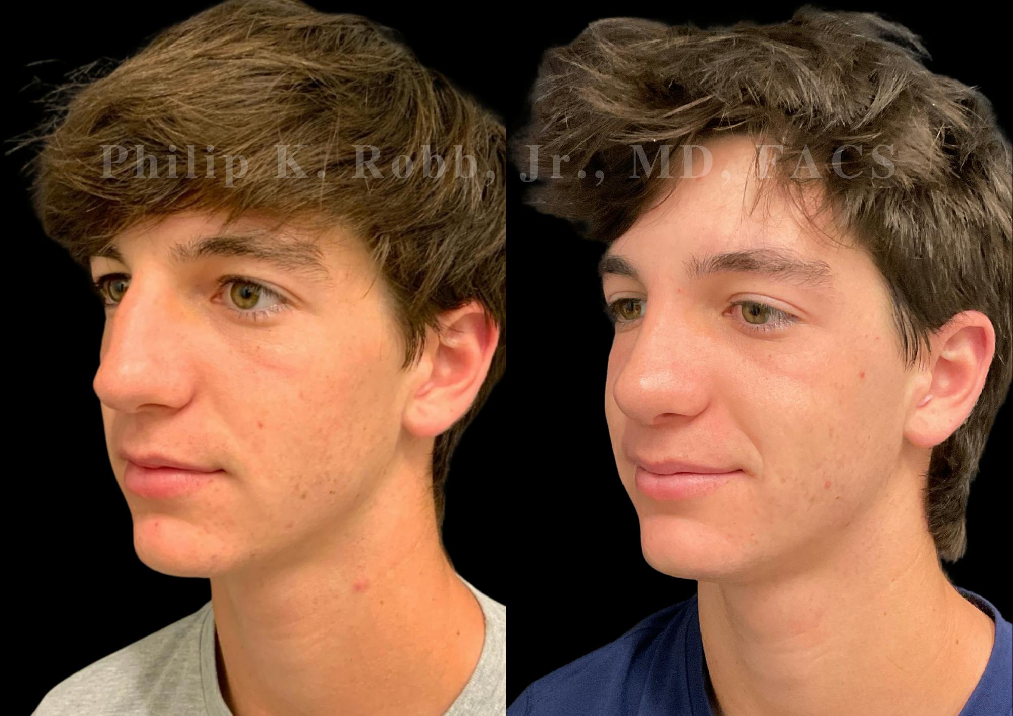 Ultrasonic Rhinoplasty Before & After Gallery - Patient 156125 - Image 4