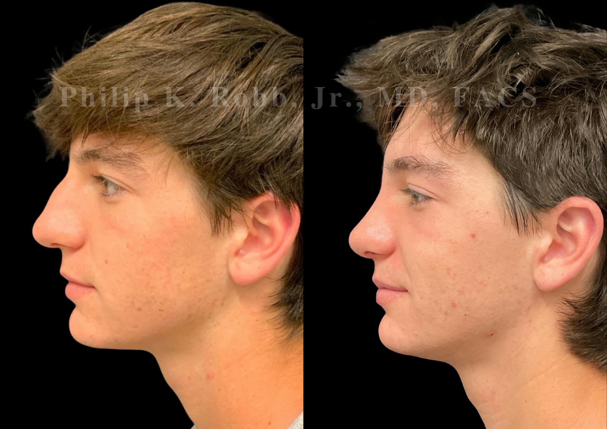 Ultrasonic Rhinoplasty Before & After Gallery - Patient 156125 - Image 5