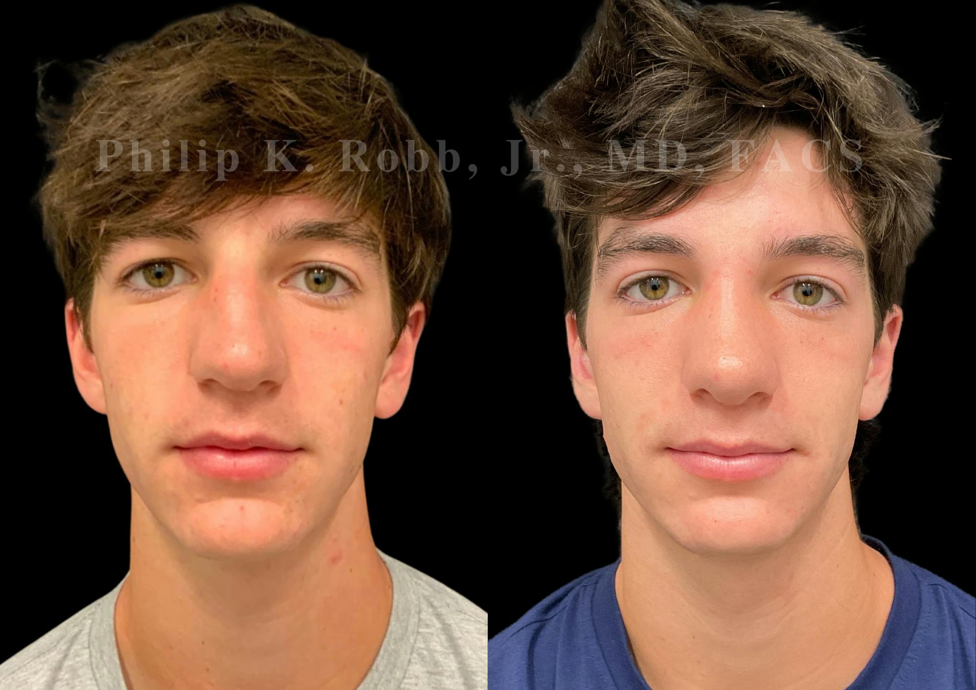 Ultrasonic Rhinoplasty Before & After Gallery - Patient 156125 - Image 3