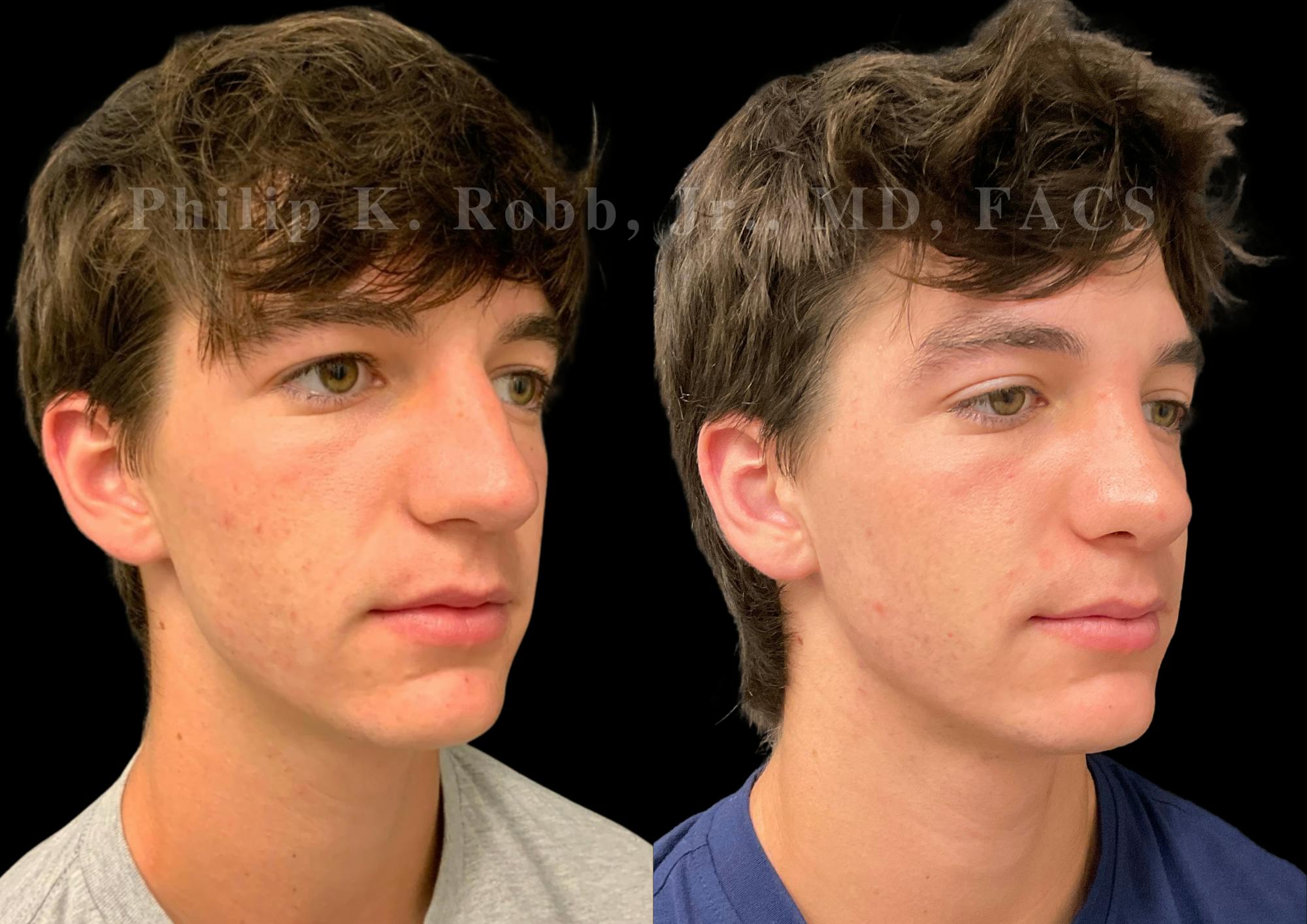 Ultrasonic Rhinoplasty Before & After Gallery - Patient 156125 - Image 2