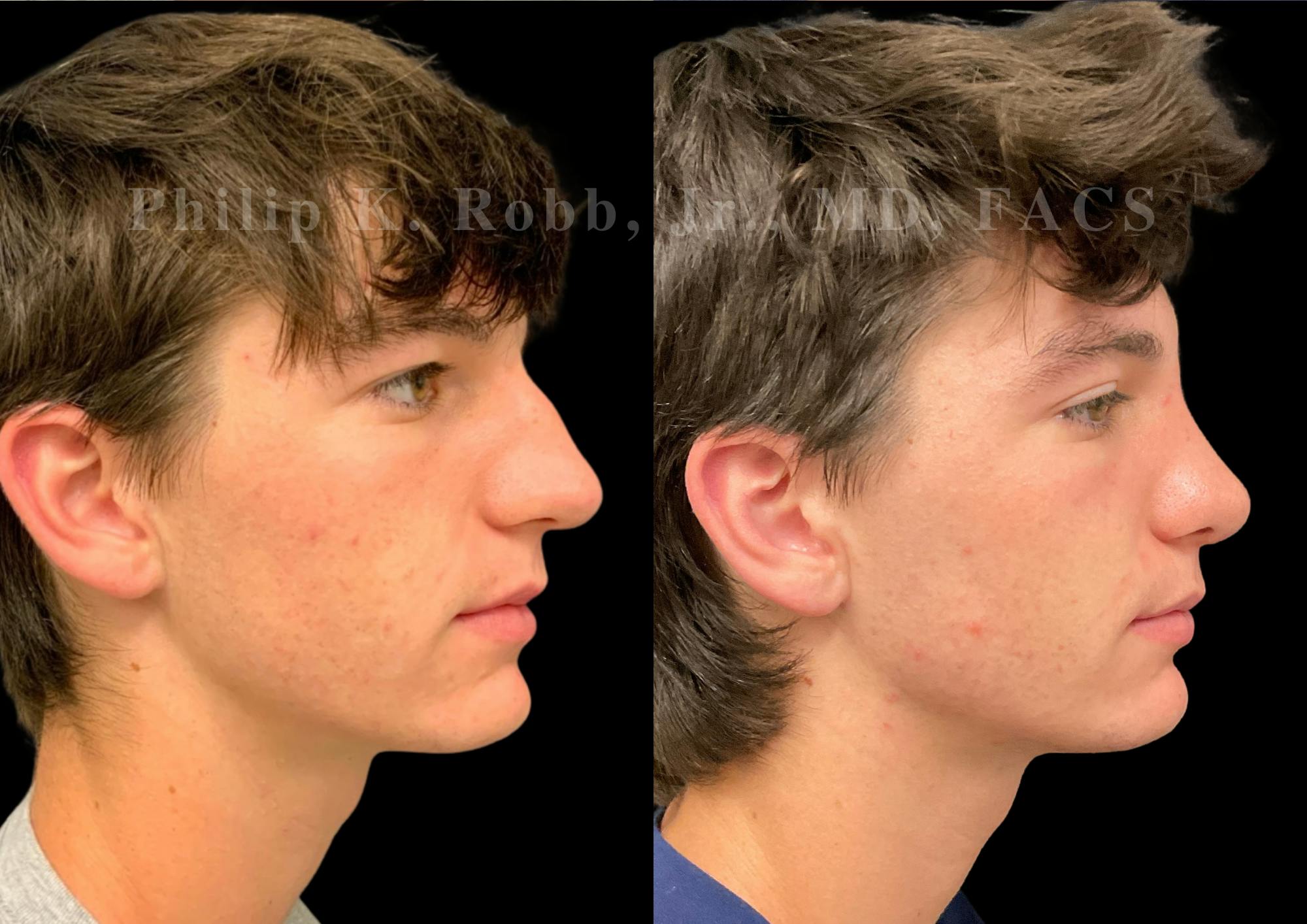Ultrasonic Rhinoplasty Before & After Gallery - Patient 156125 - Image 1