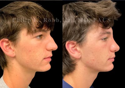 Ultrasonic Rhinoplasty Before & After Gallery - Patient 156125 - Image 1