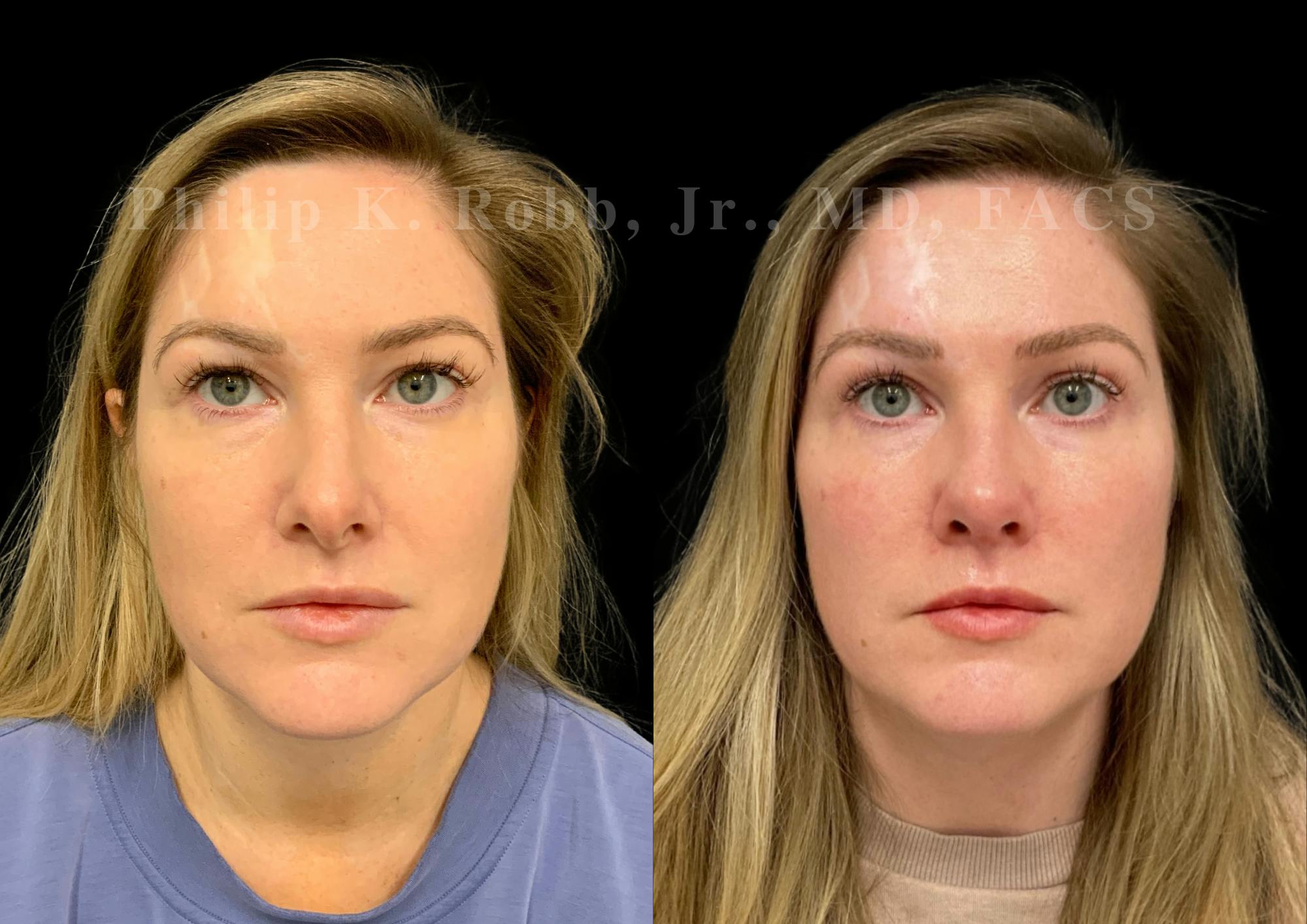 Ultrasonic Rhinoplasty Before & After Gallery - Patient 167233 - Image 3