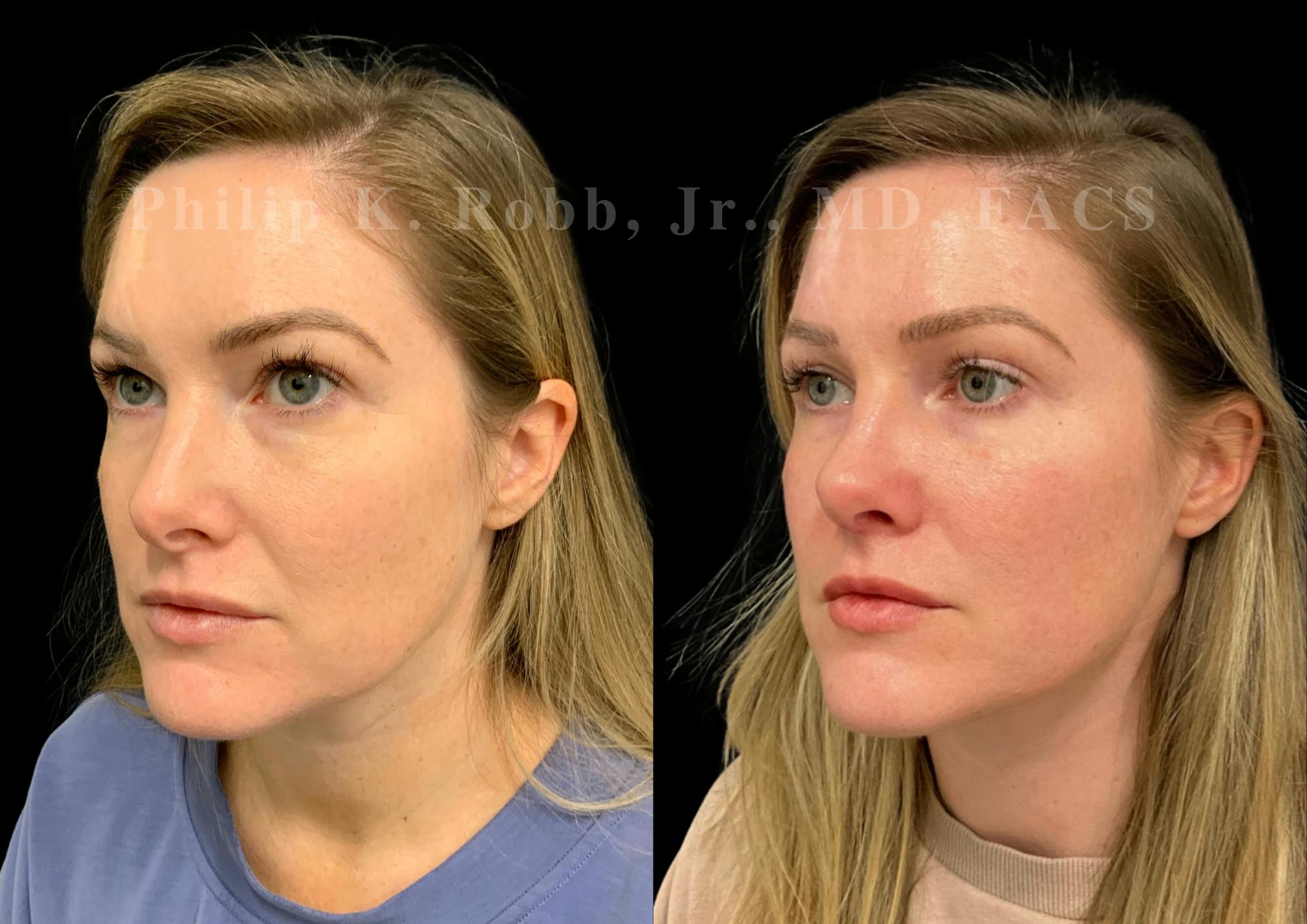 Ultrasonic Rhinoplasty Before & After Gallery - Patient 167233 - Image 4