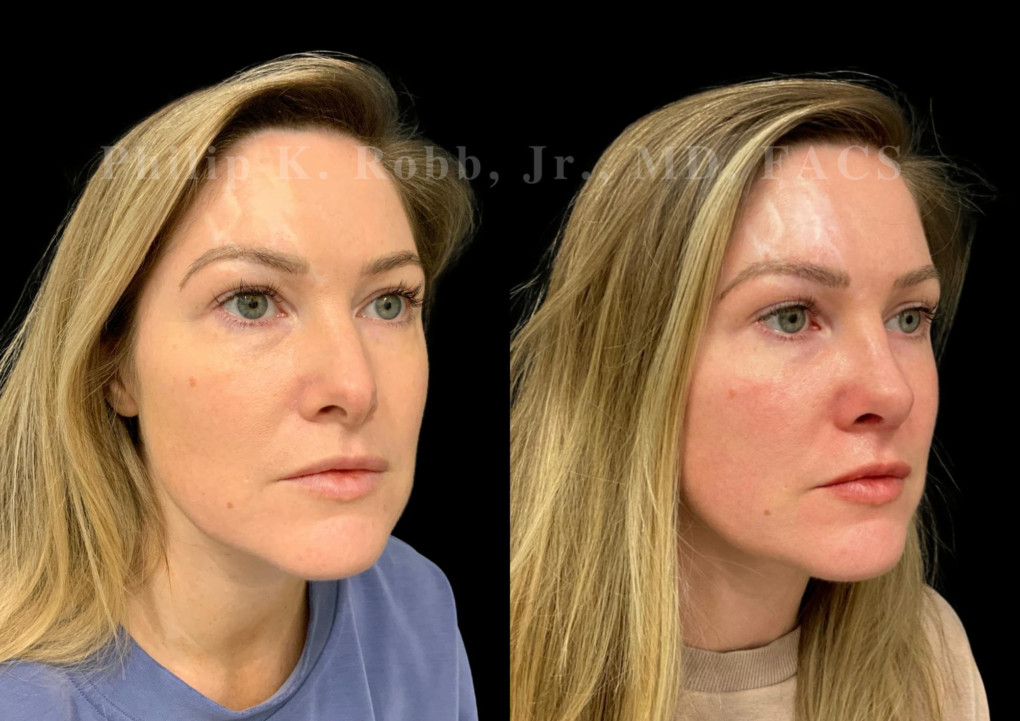 Ultrasonic Rhinoplasty Before & After Gallery - Patient 167233 - Image 2