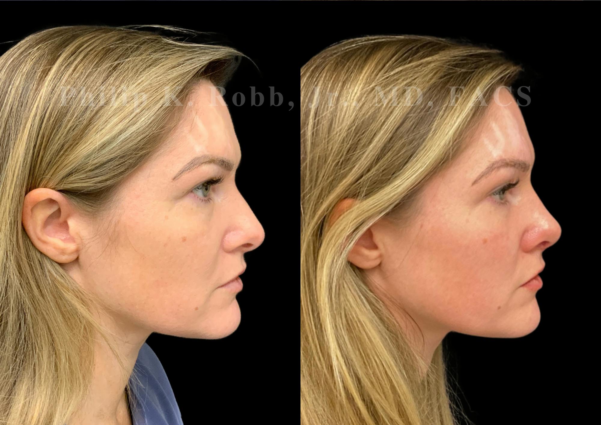 Ultrasonic Rhinoplasty Before & After Gallery - Patient 167233 - Image 1
