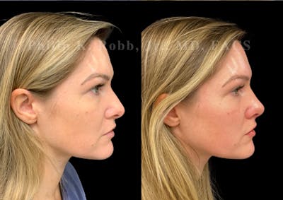 Ultrasonic Rhinoplasty Before & After Gallery - Patient 167233 - Image 1