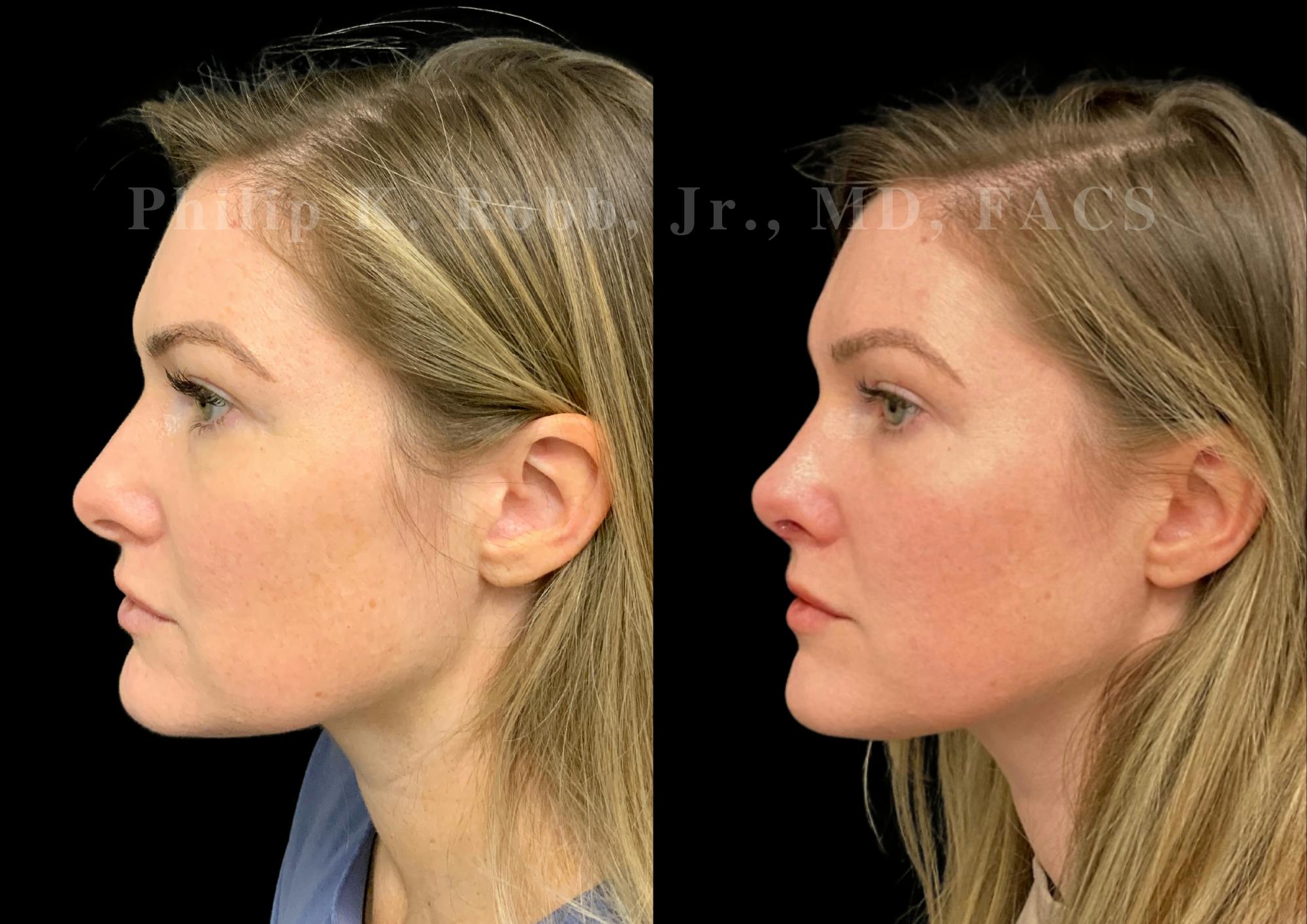 Ultrasonic Rhinoplasty Before & After Gallery - Patient 167233 - Image 5