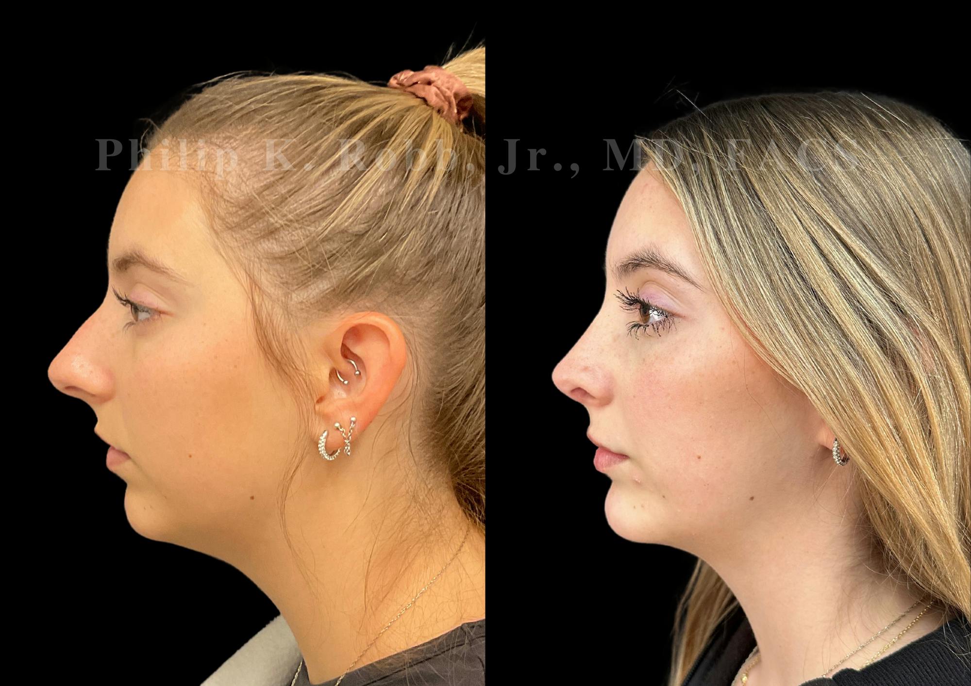 Ultrasonic Rhinoplasty Before & After Gallery - Patient 146930 - Image 5