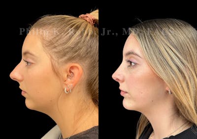 Chin Augmentation Before & After Gallery - Patient 109343 - Image 1