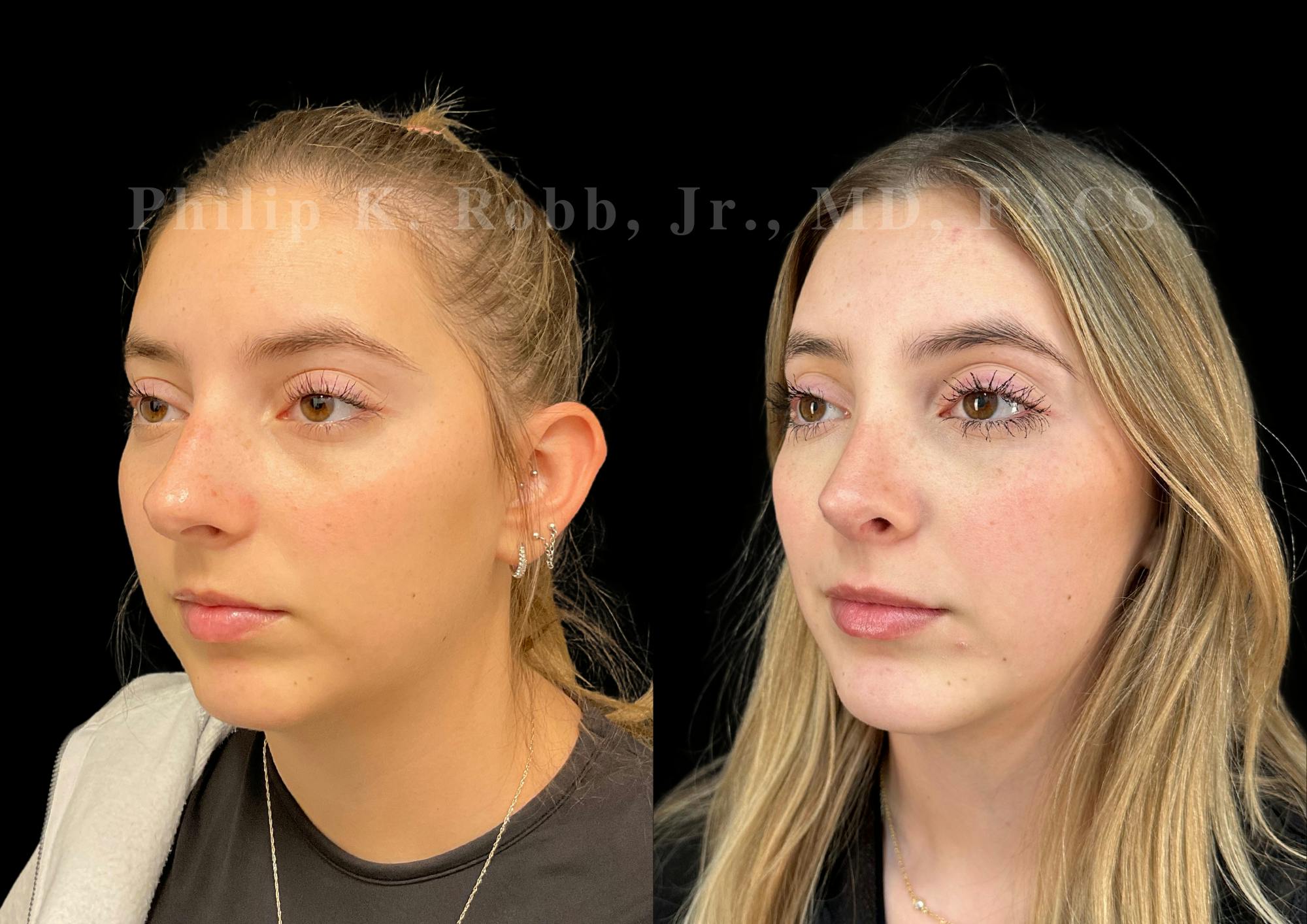 Ultrasonic Rhinoplasty Before & After Gallery - Patient 146930 - Image 4