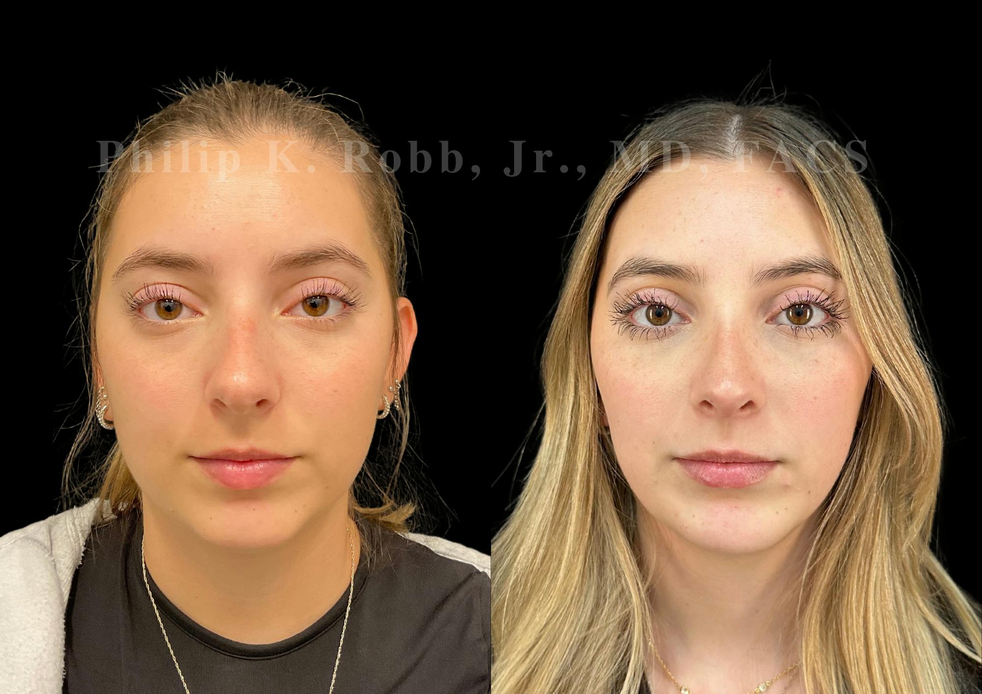 Ultrasonic Rhinoplasty Before & After Gallery - Patient 146930 - Image 3