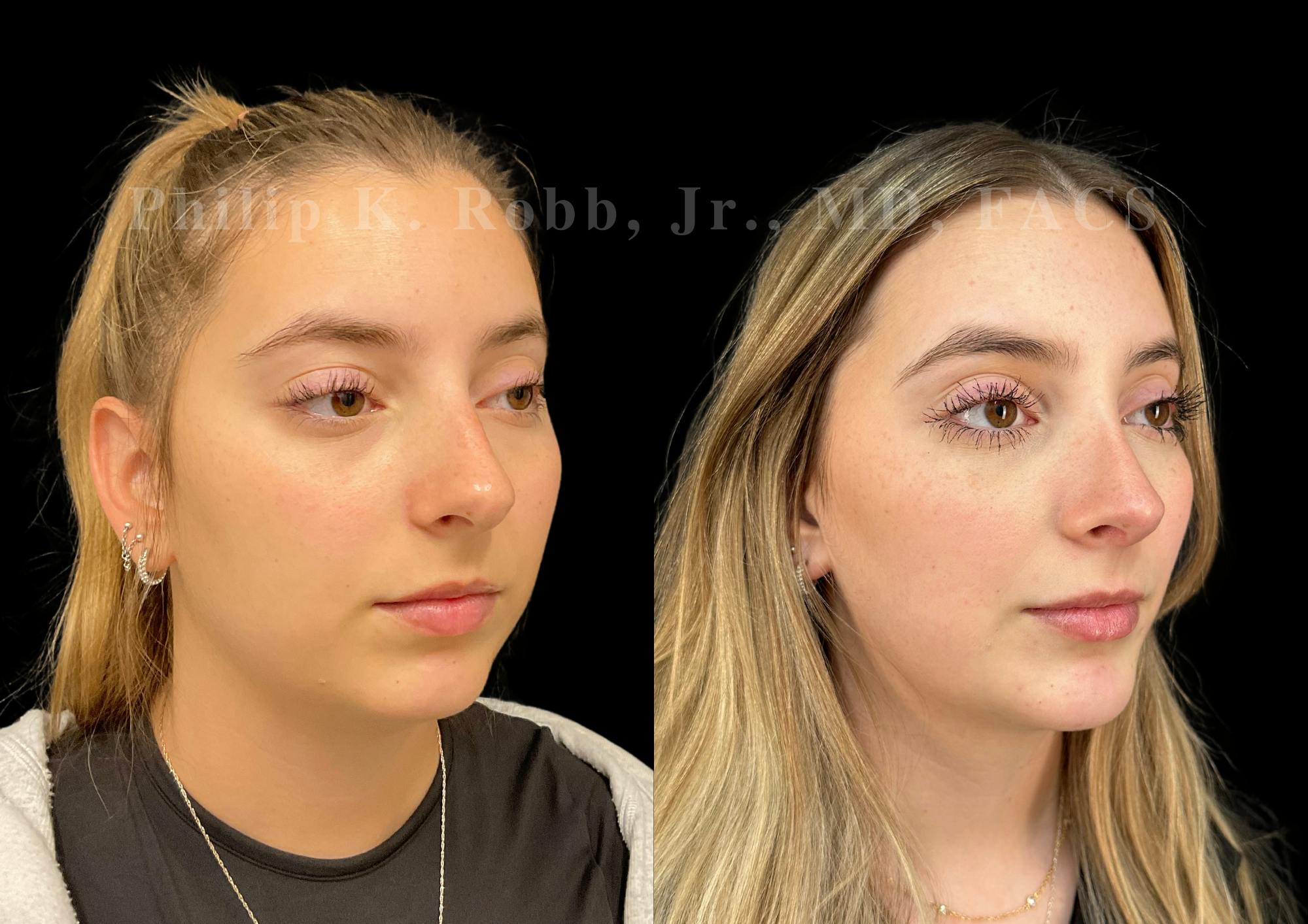 Ultrasonic Rhinoplasty Before & After Gallery - Patient 146930 - Image 2