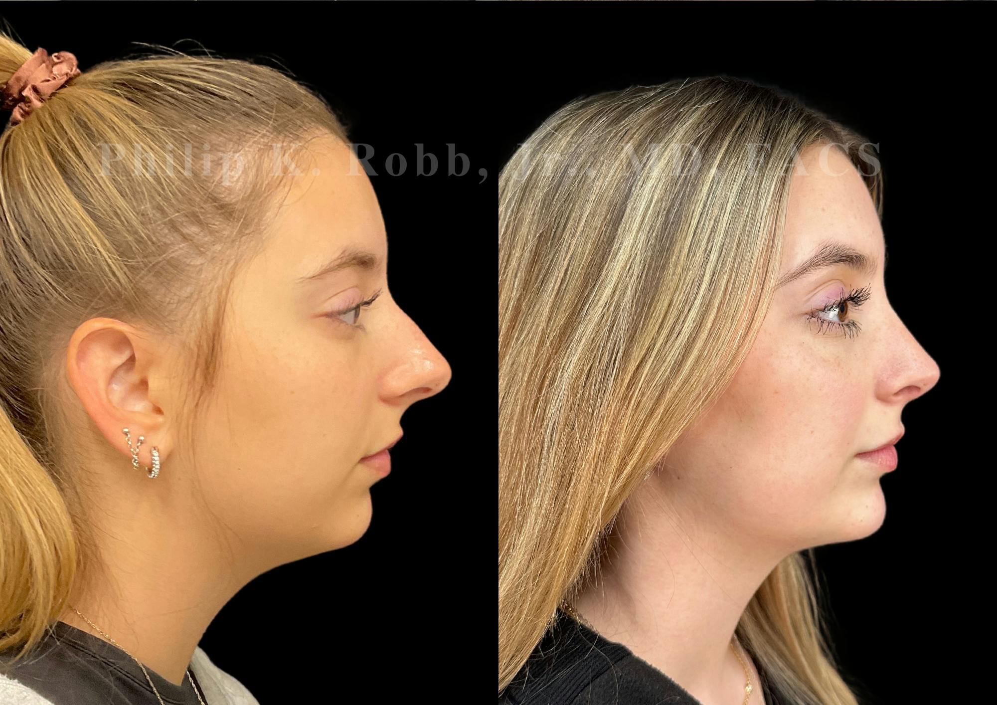 Ultrasonic Rhinoplasty Before & After Gallery - Patient 146930 - Image 1